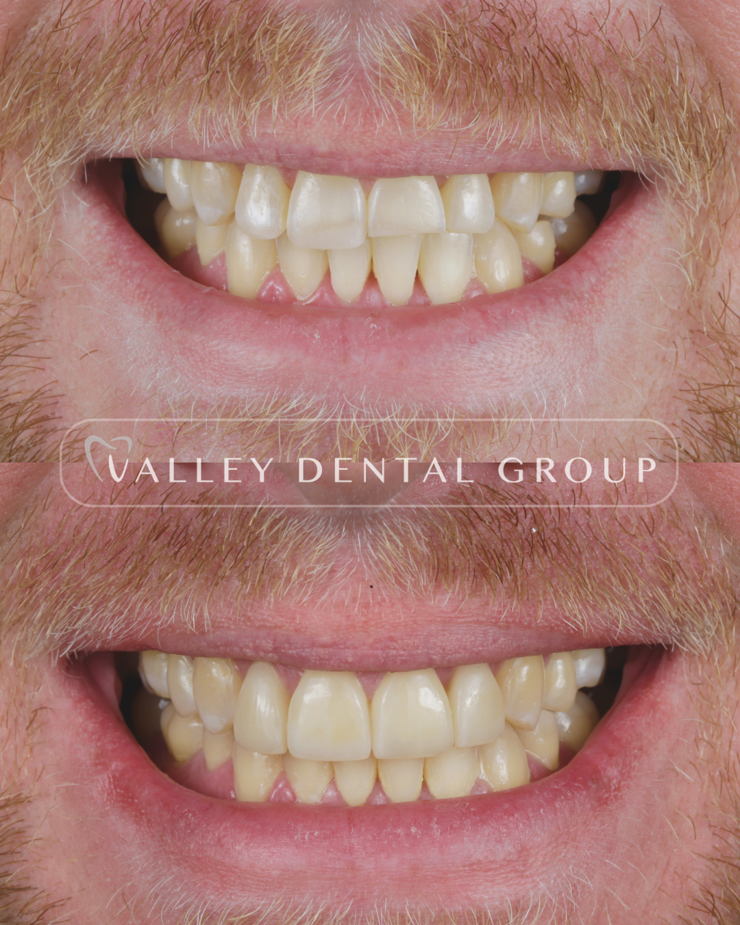 Comparison of teeth before and after dental treatment, showing improved alignment and whitening.