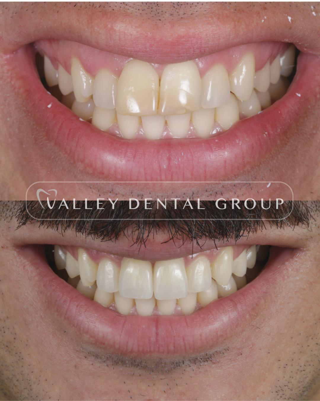A close-up of two smiling mouths with visible teeth, showing a difference in dental appearance and possibly dental work, with the text 'Walley Dental Group' overlaid in the middle.