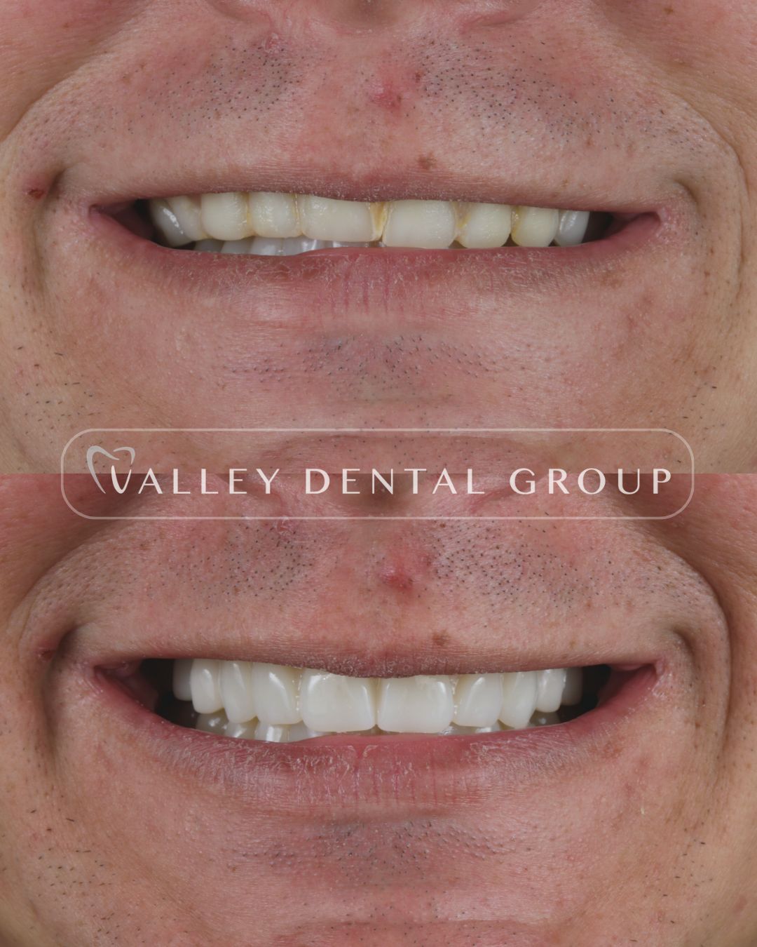 Close-up of a person's smile showing their teeth before and after dental work, with a watermark for Valley Dental Group.