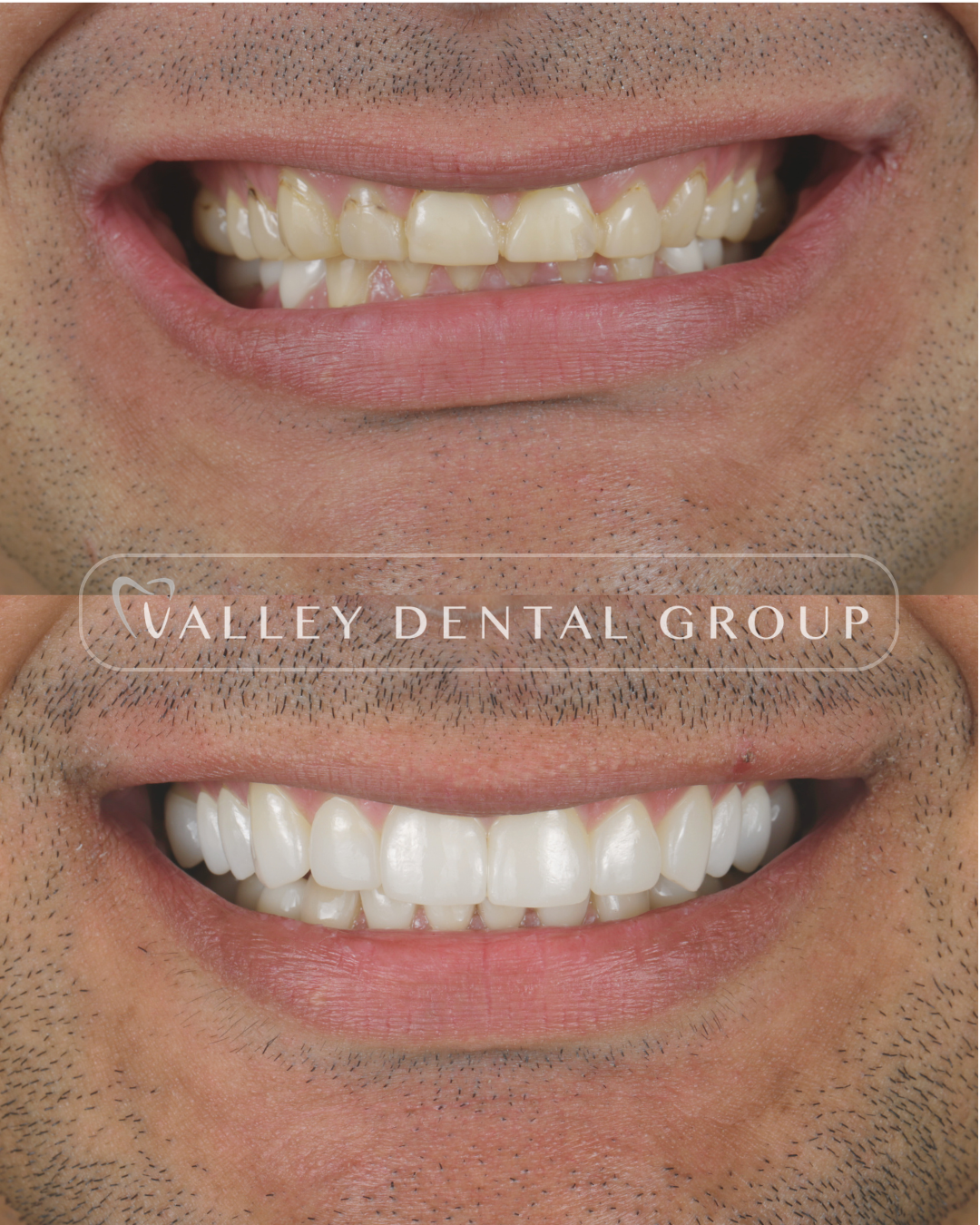 Before and after close-up of a person's smile showing dental improvement, with the second image displaying whiter, straighter teeth. Work of Prosthodontist in Phoenix Arizona.