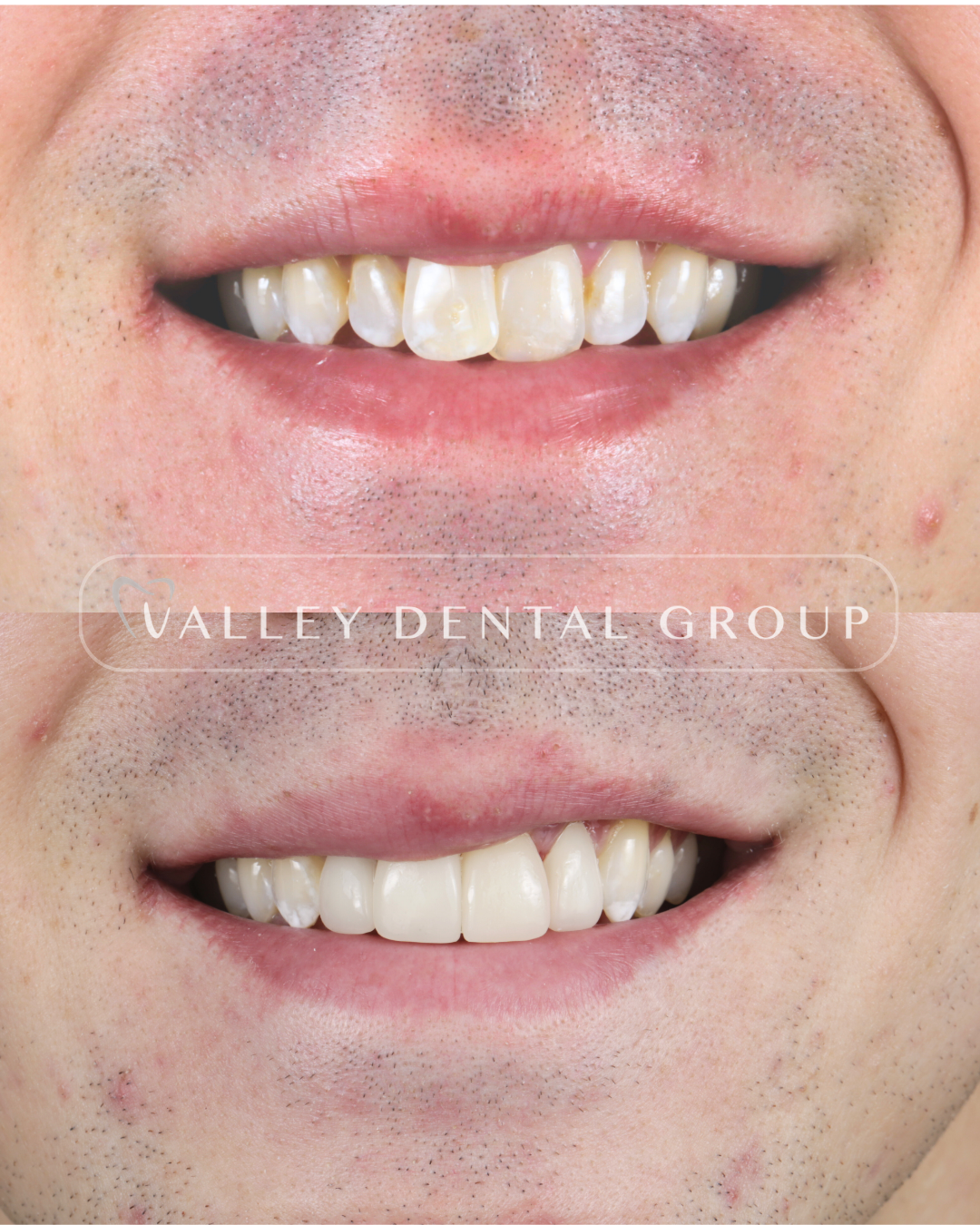 Close-up of a person's smiling mouth showing before and after dental treatment, with stained and misaligned teeth in the top image and clean, straight teeth in the bottom image.