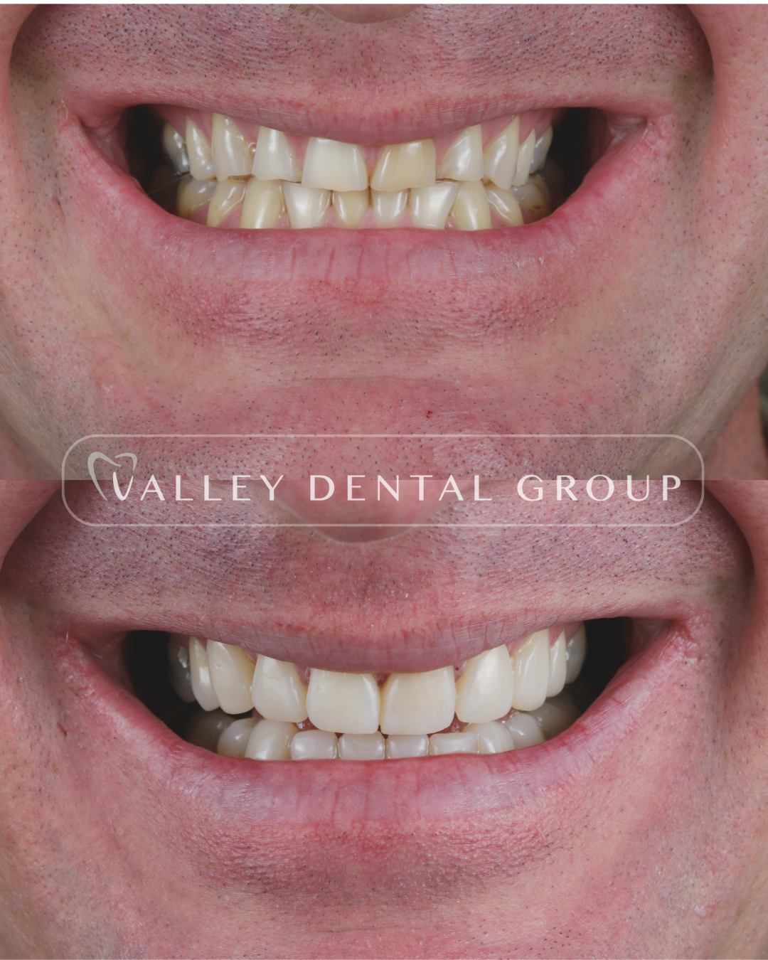 Close-up of a person's smile showing teeth before and after dental treatment at Valley Dental Group.