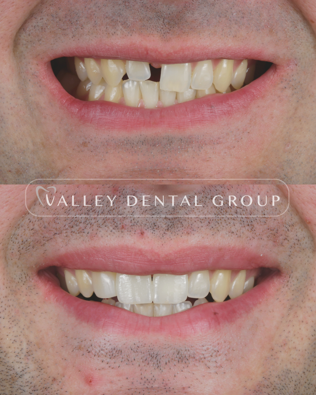 Close-up comparison of a person's teeth, showing before and after dental treatment, with the 'Valley Dental Group' watermark.