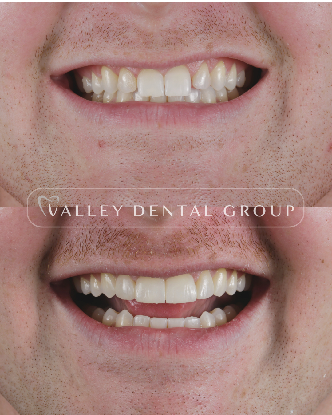 Close-up of a person's smile showing before and after dental work, with healthy white teeth after treatment.