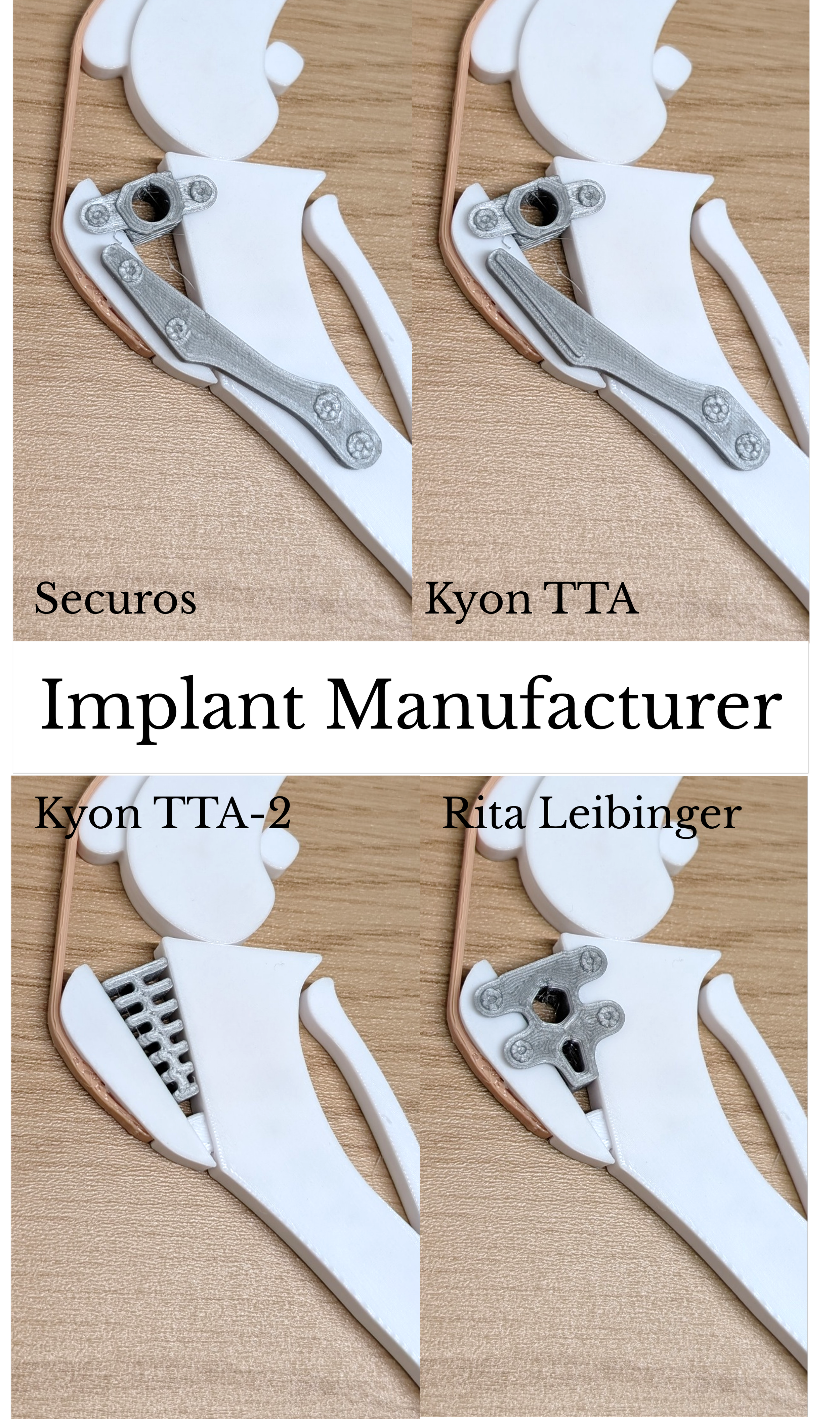 TTA Implants.png
