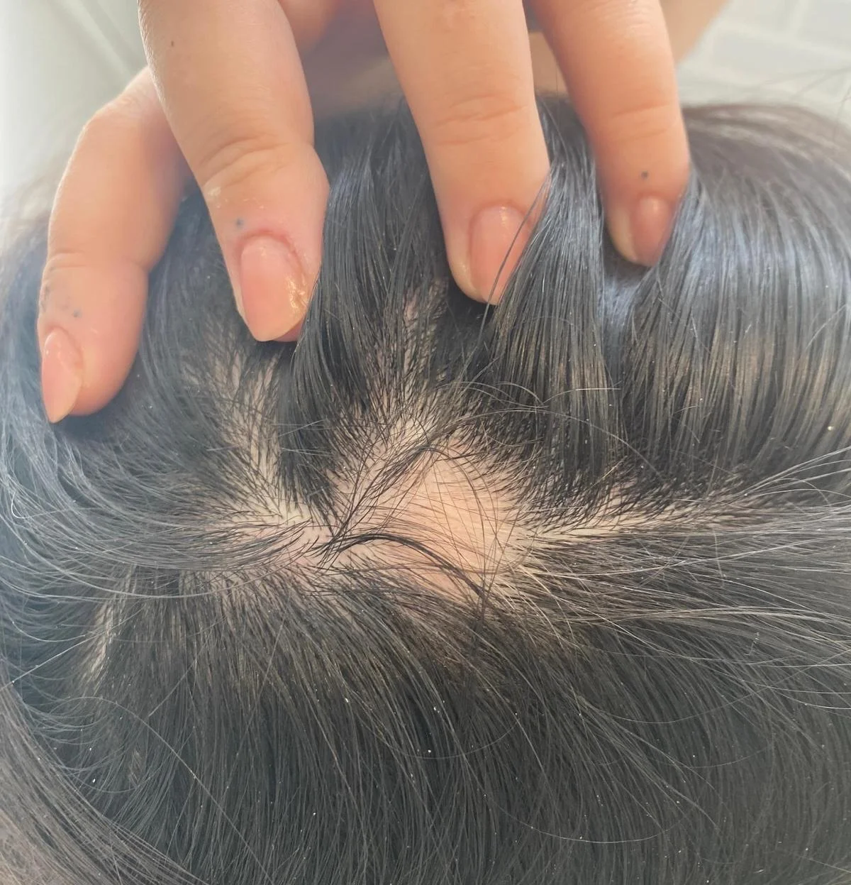 Christmas Eve, when I was an early teenager, I found my first bald patch. It shocked me to my core.

For years, I lived in fear of someone noticing. I dreaded going to the hairdressers, terrified they&rsquo;d find another patch and have to be the one