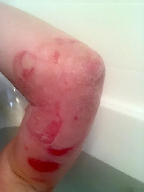 Sakura Sutter's Experience with Pemphigus Vulgaris