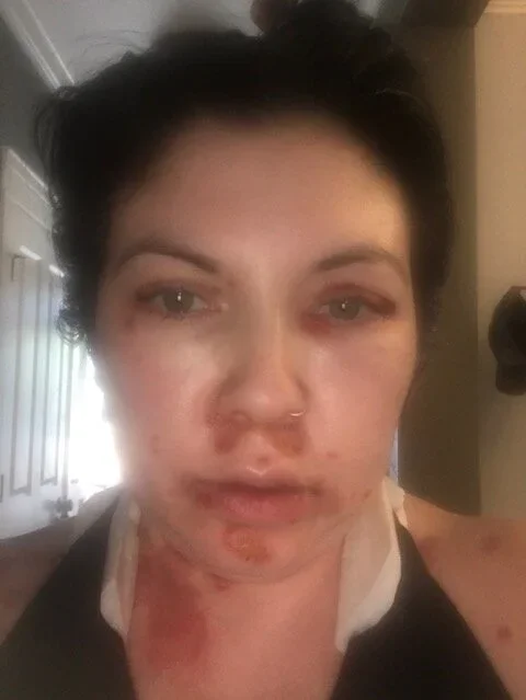 Sakura Sutter's Experience with Pemphigus Vulgaris