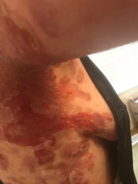 Sakura Sutter's Experience with Pemphigus Vulgaris