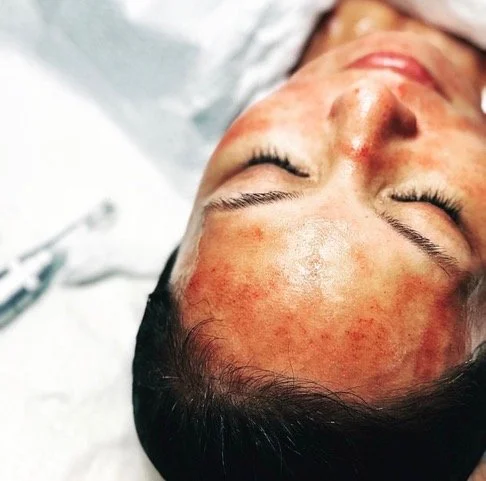 Microneedling