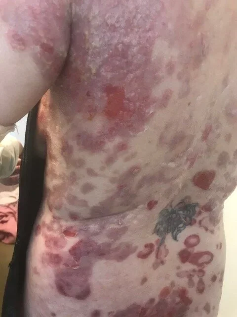 Sakura Sutter's Experience with Pemphigus Vulgaris