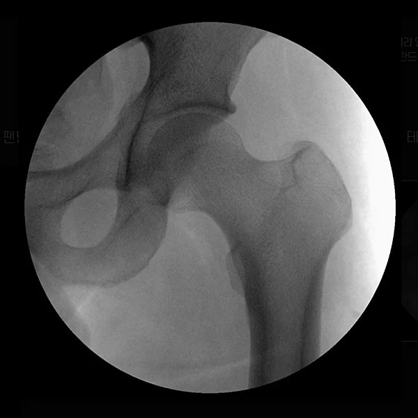 Take 23. Hip Joint without Filter