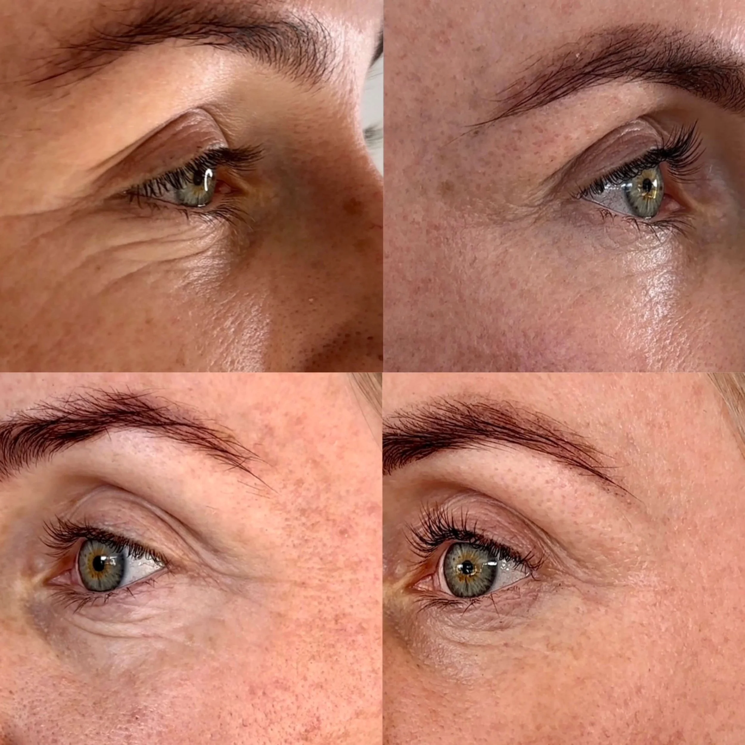 Close-up images of female eyes before and after cosmetic skincare or treatment, showing reduced wrinkles and smoother skin.