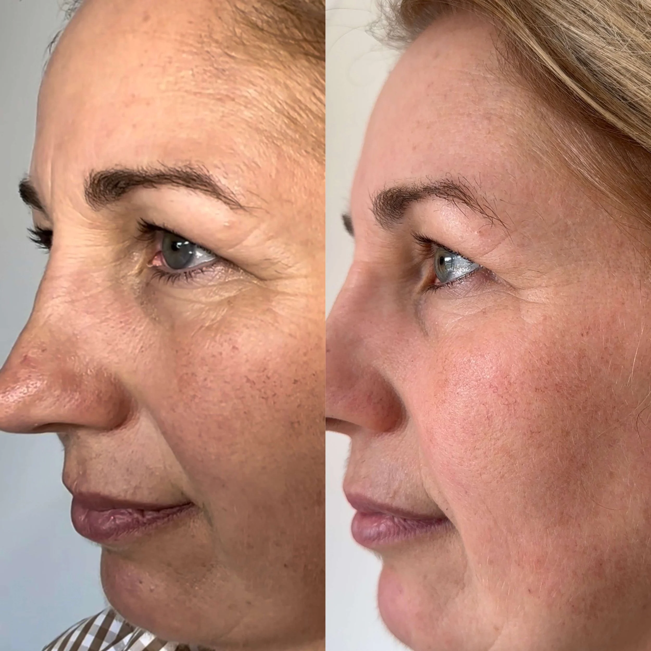 Side-by-side comparison of a woman's face showing skin improvement, with smoother skin, fewer wrinkles, and a more even complexion in the right image.