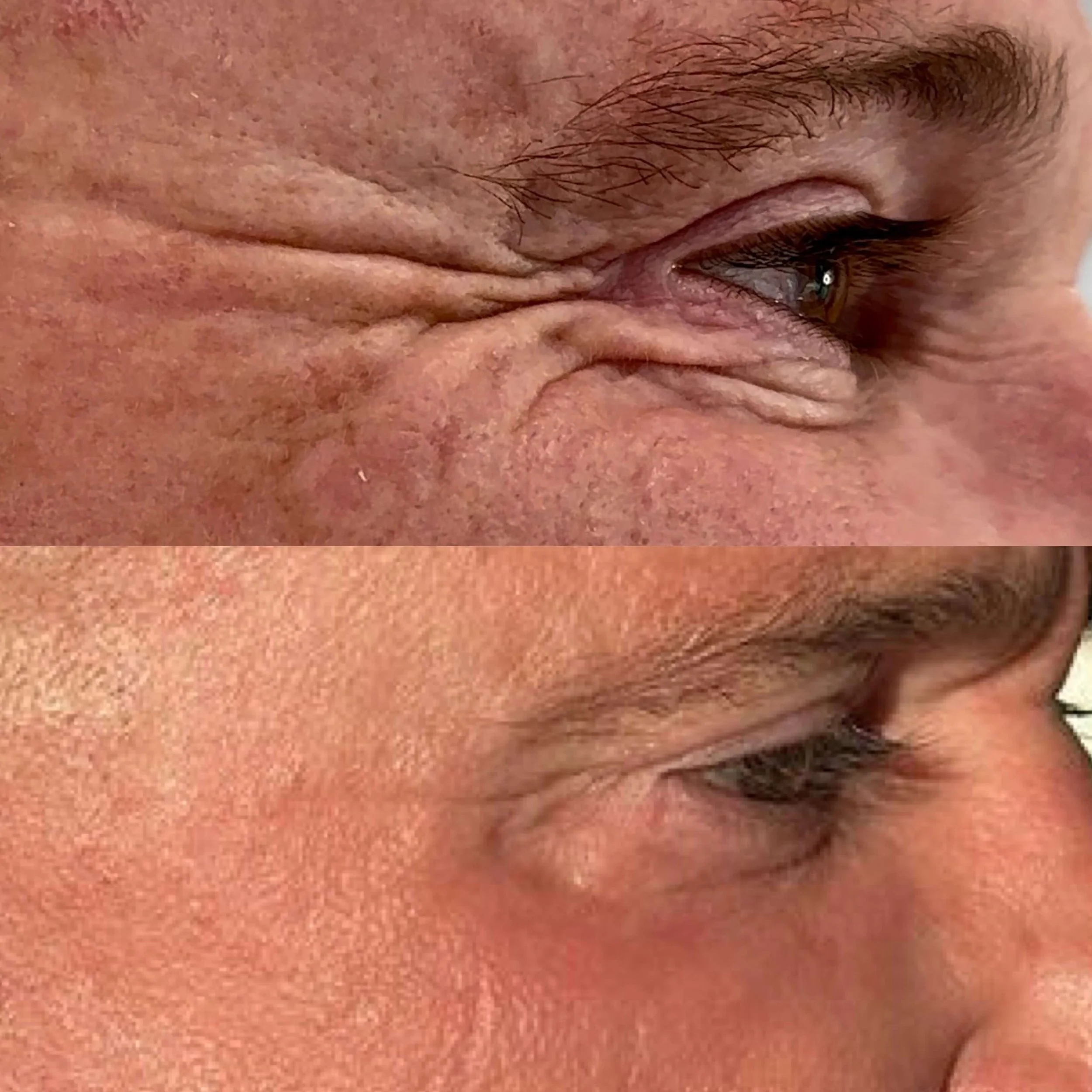 Close-up comparison of a person's face showing a reduction in facial wrinkles around the eye area, demonstrating before and after skin treatment results.