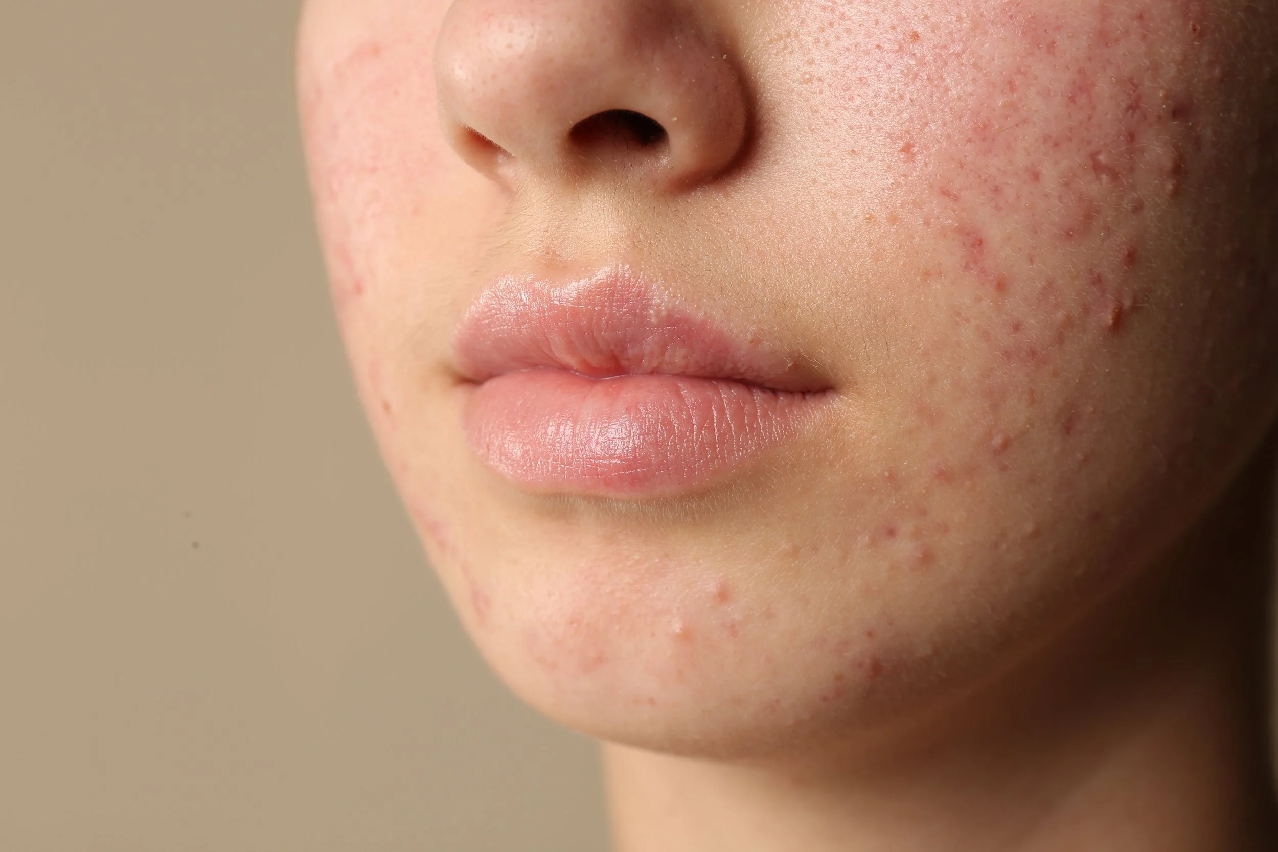Close-up of a person's face showing skin blemishes, redness, and acne on the cheeks and around the mouth.