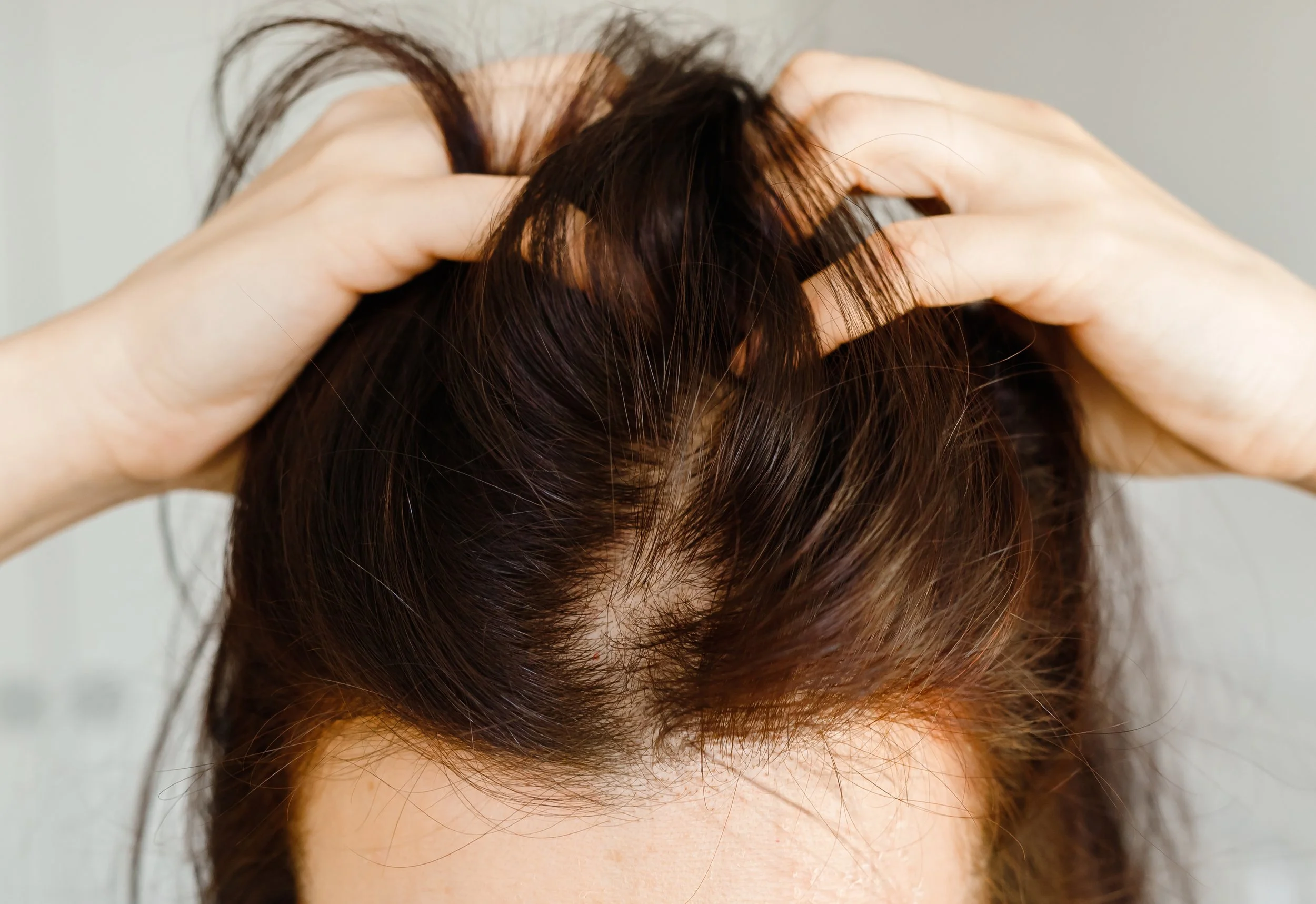 Person with reddish-brown hair holding their scalp with both hands, showing scalp and hair roots.