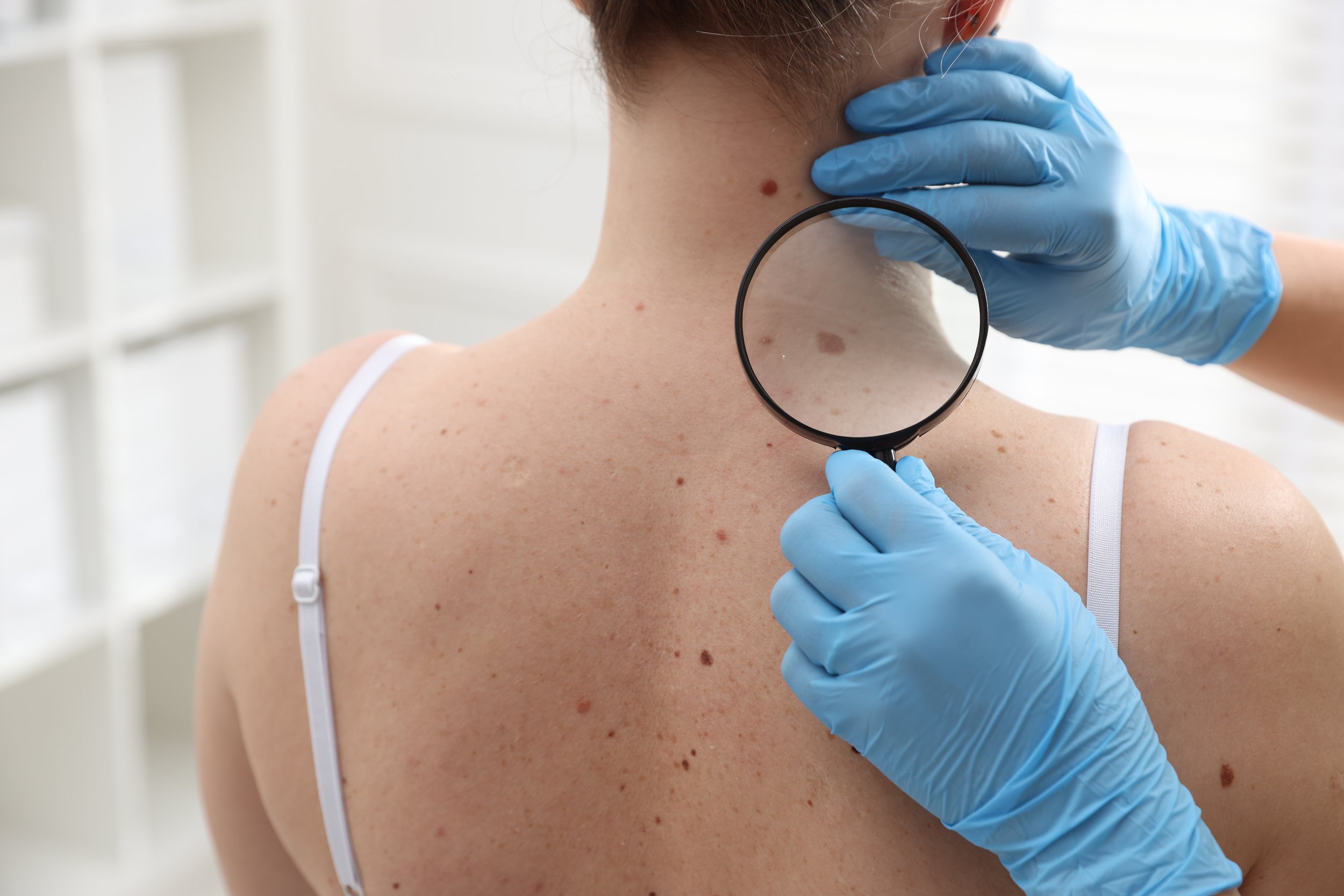 A doctor wearing blue gloves examines a woman's skin with a magnifying glass, focusing on moles and skin spots on her shoulder and neck.