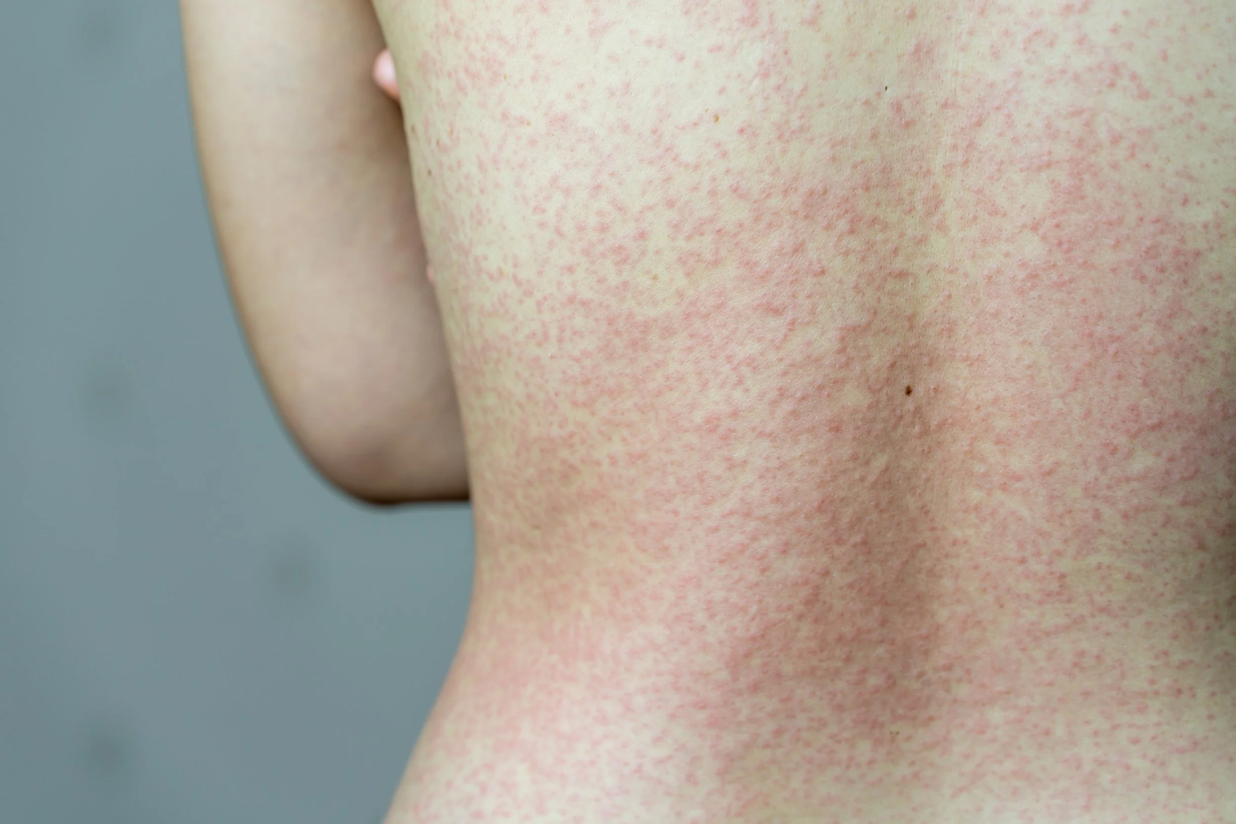 Close-up of a person's back showing skin redness and small bumps, possibly indicating a skin irritation or rash.