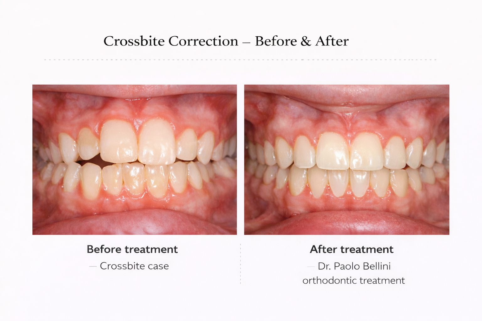 Comparison of teeth before and after orthodontic treatment showing improved alignment and bite correction with images labeled 'Before treatment' and 'After treatment'.