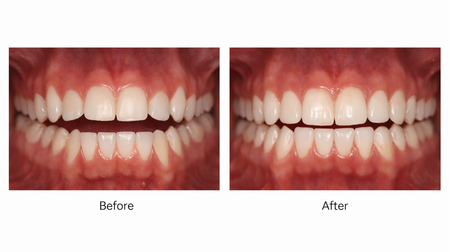 Comparison of teeth before and after whitening treatment, showing brighter teeth in the after image.