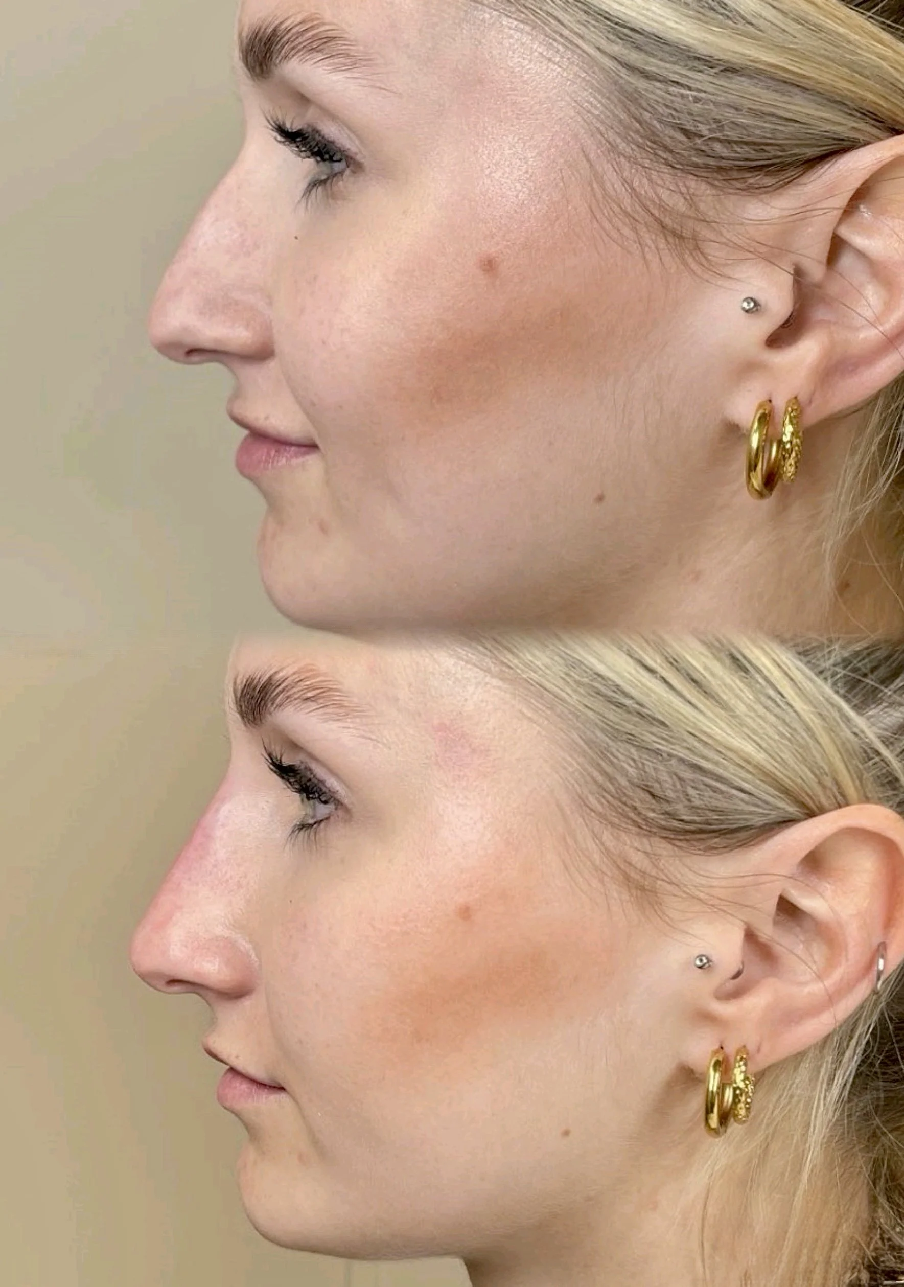 Side-by-side comparison of a woman's face before and after skincare treatment, highlighting improved skin texture and clarity.