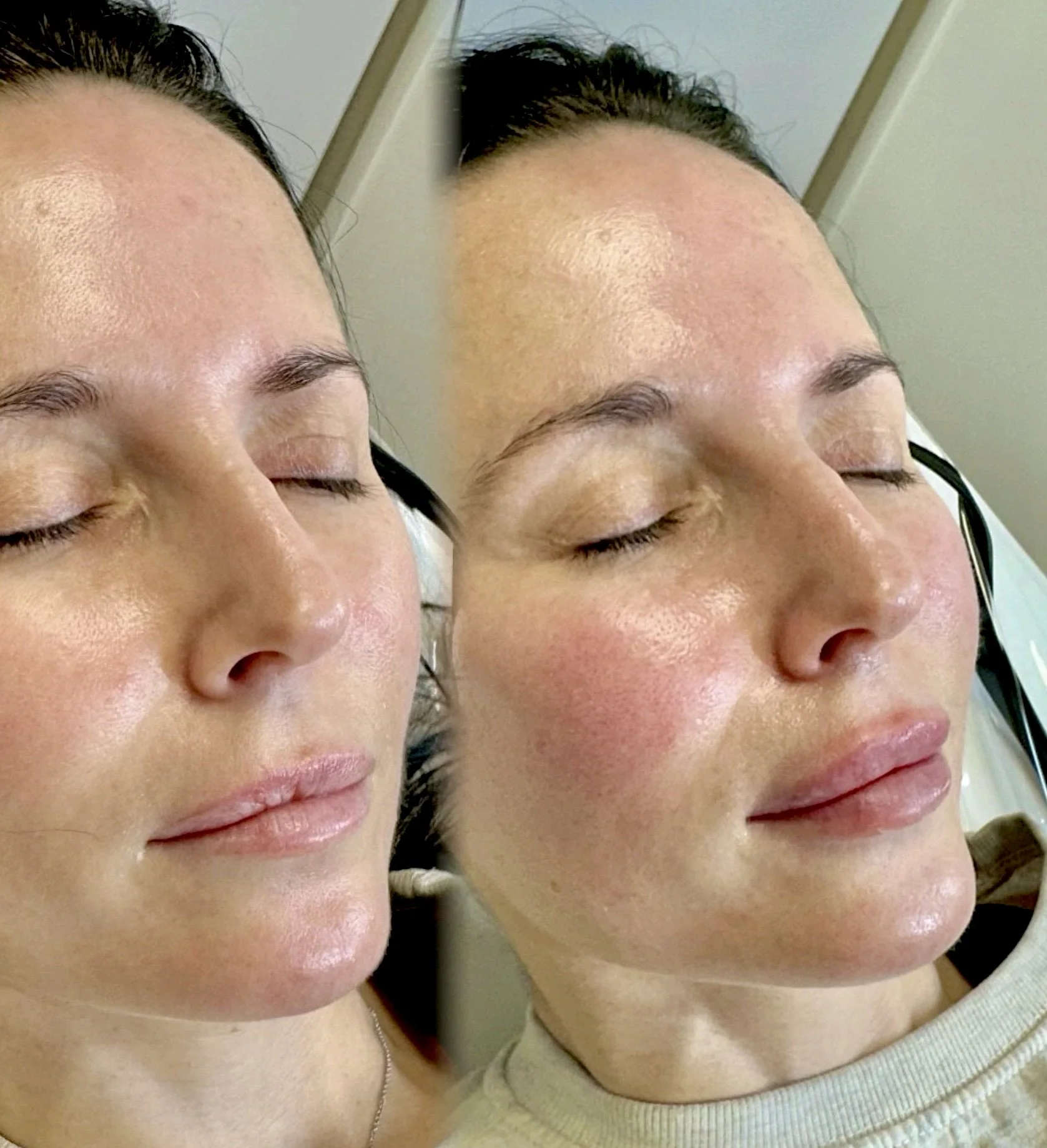 Side-by-side comparison of a woman before and after a cosmetic procedure, showing changes in her hairline and forehead area.