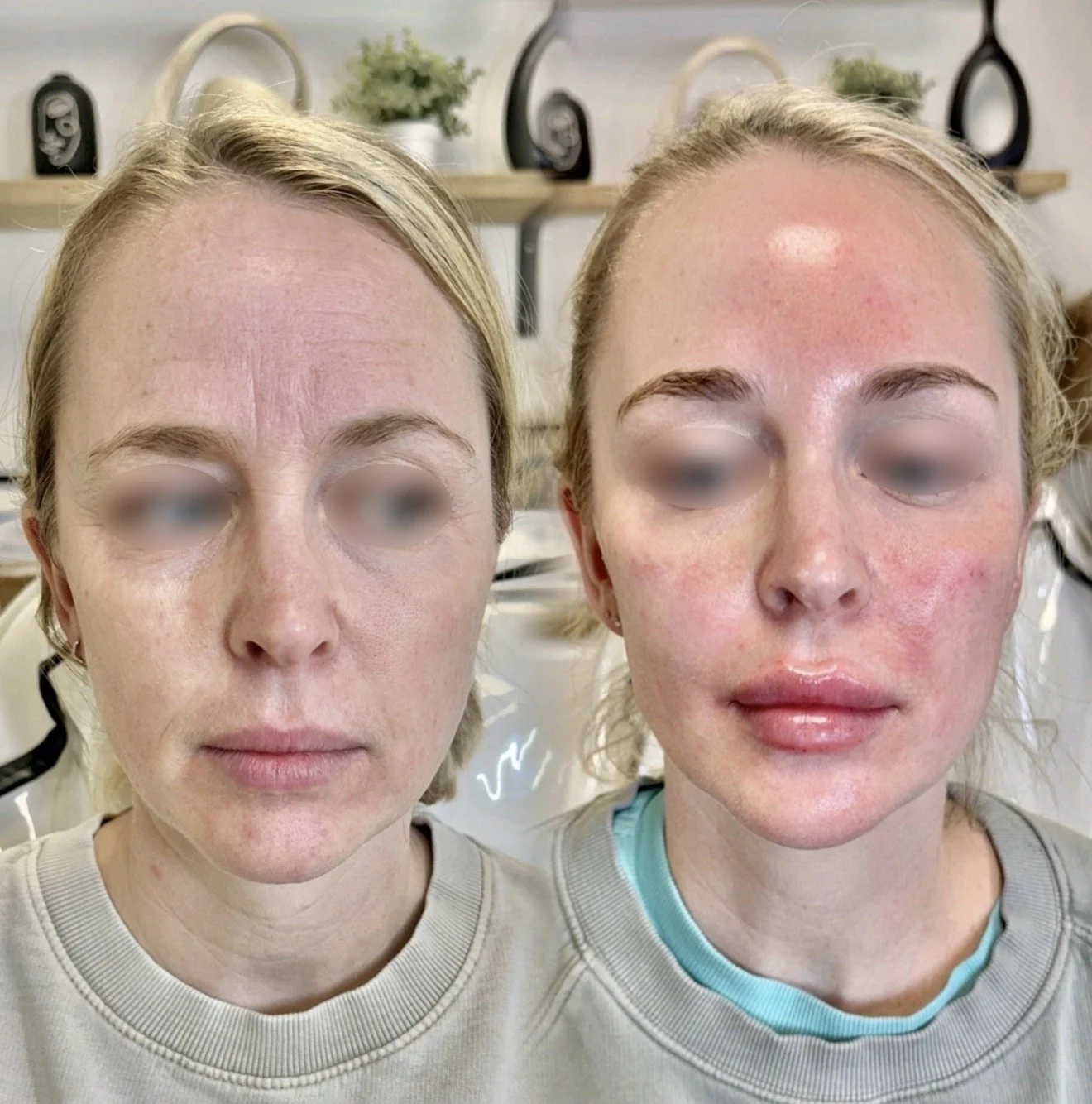 Side-by-side comparison of a woman before and after skincare treatment, showing improved skin texture and reduced redness on the right.