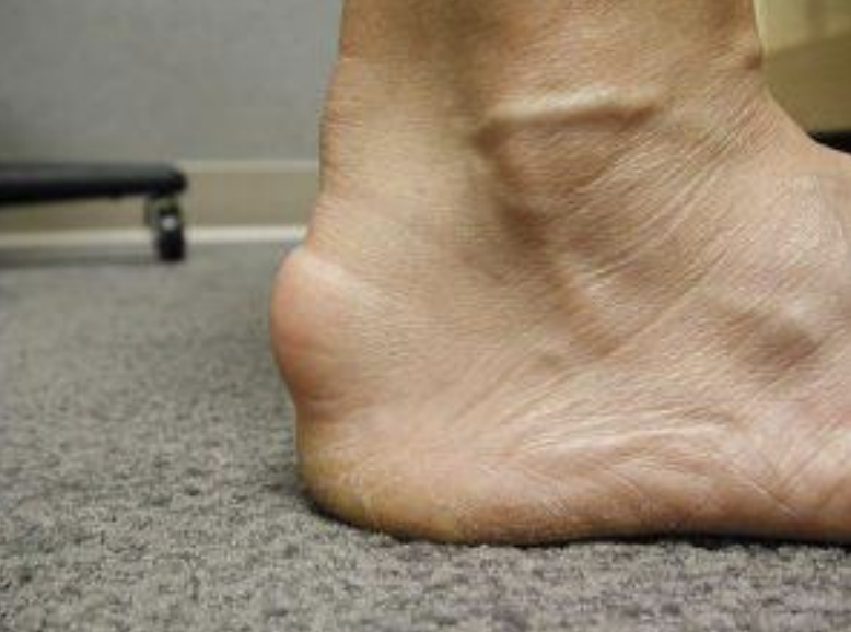 Insertional Achilles Tendonitis and how to treat it