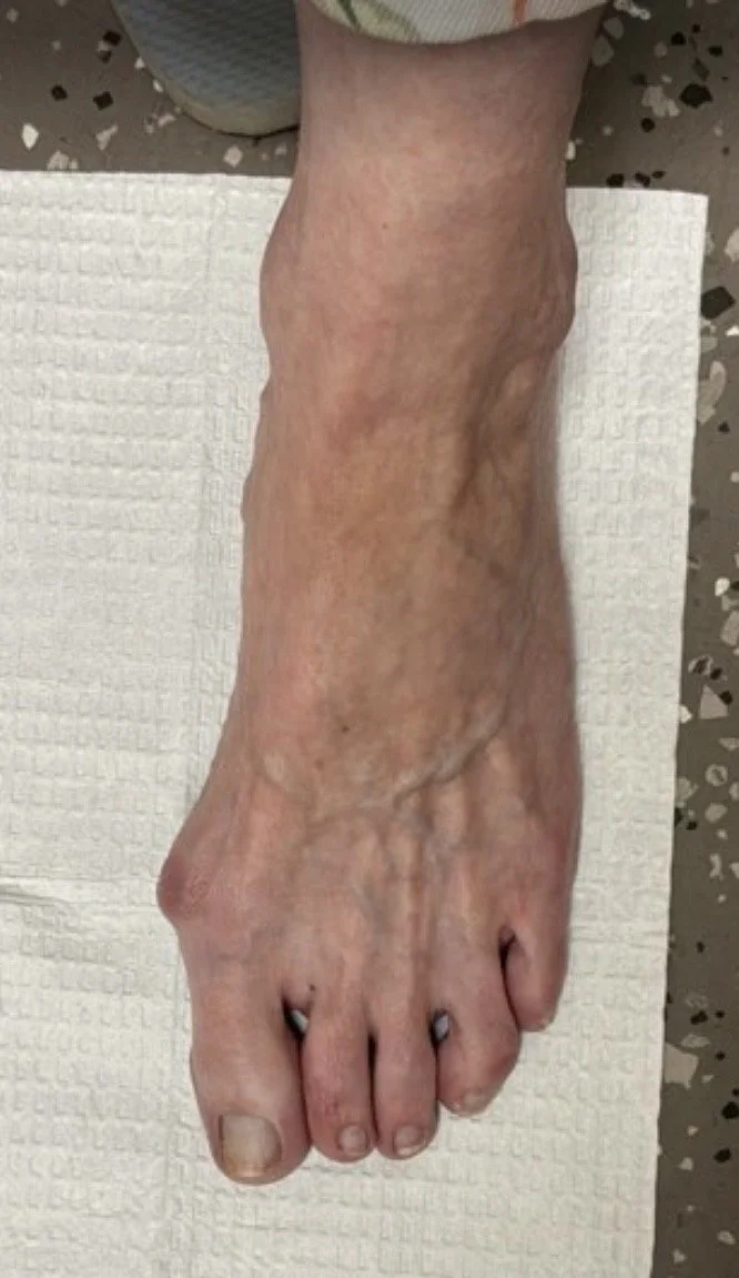 MIS-Bunion.jpg