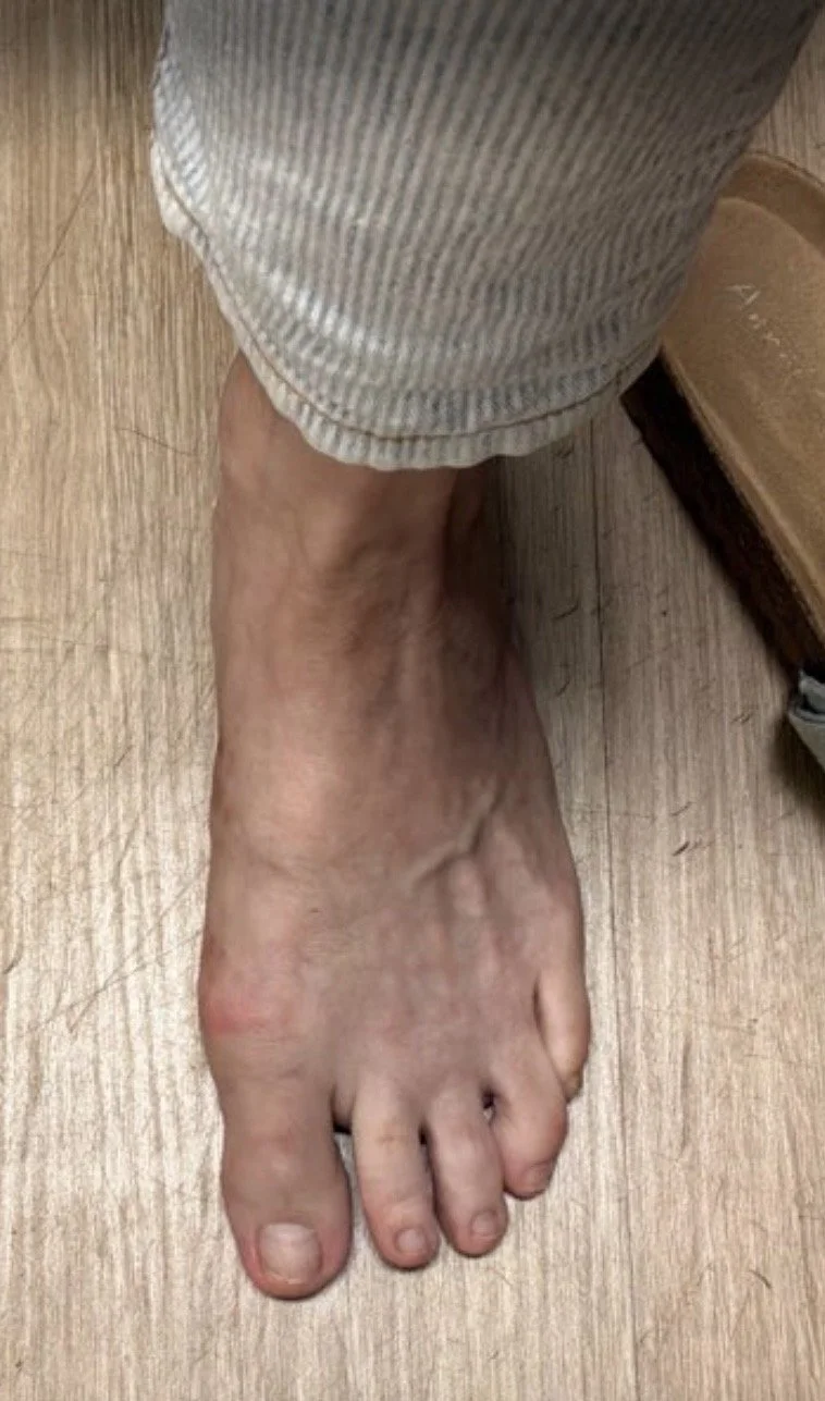 MIS-Bunion-2.jpg