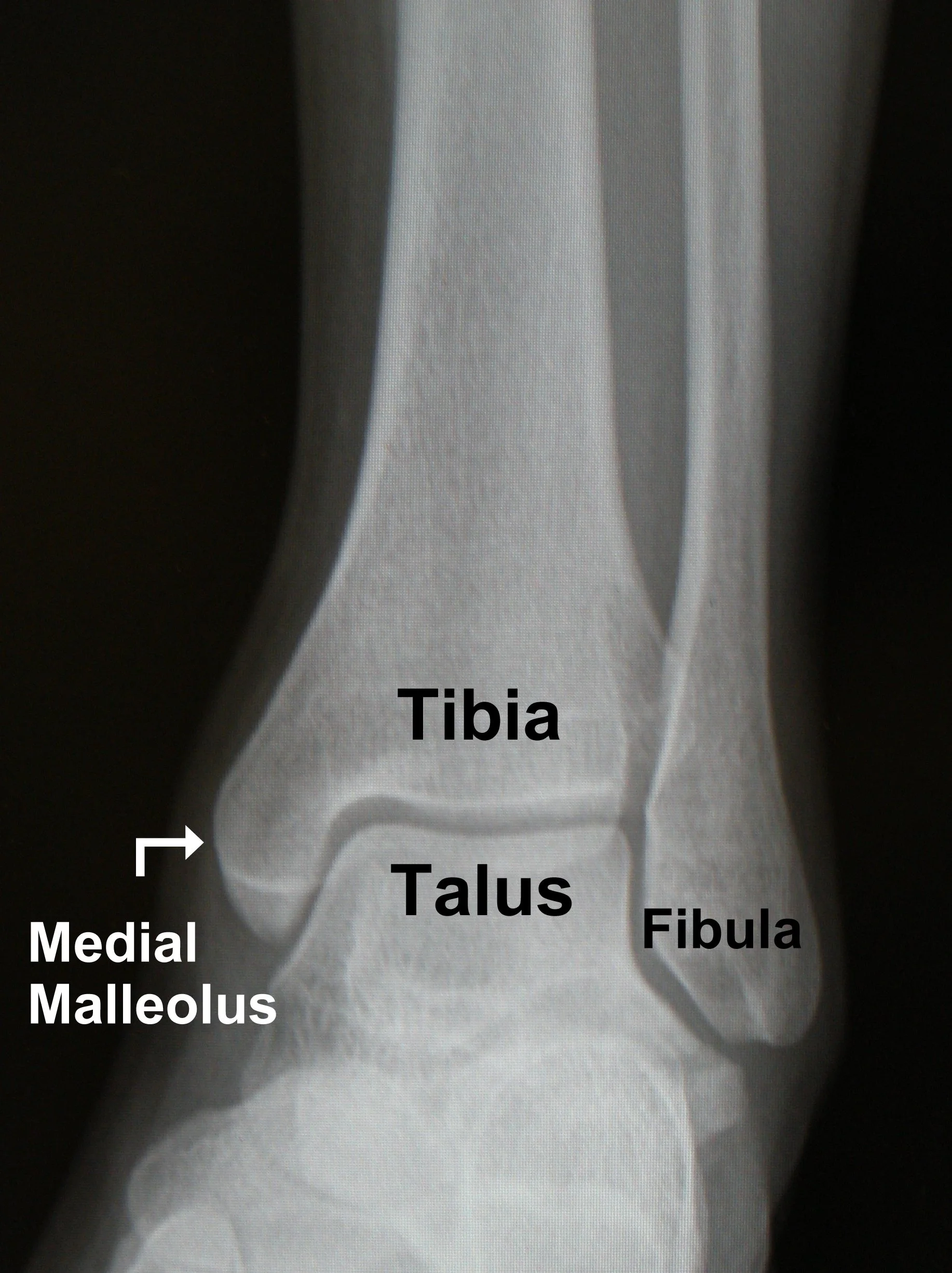 I broke my Ankle, what do I do?