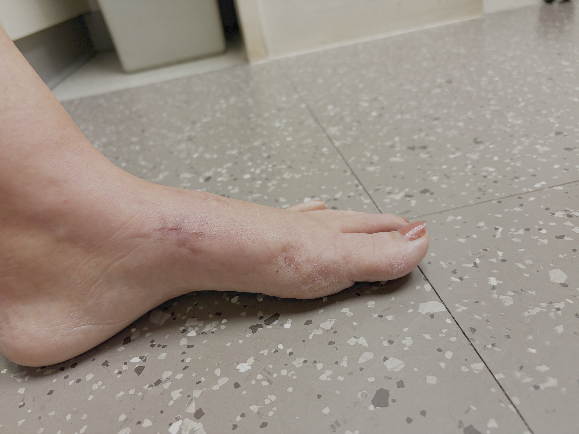 After picture of MIS Bunion Surgery