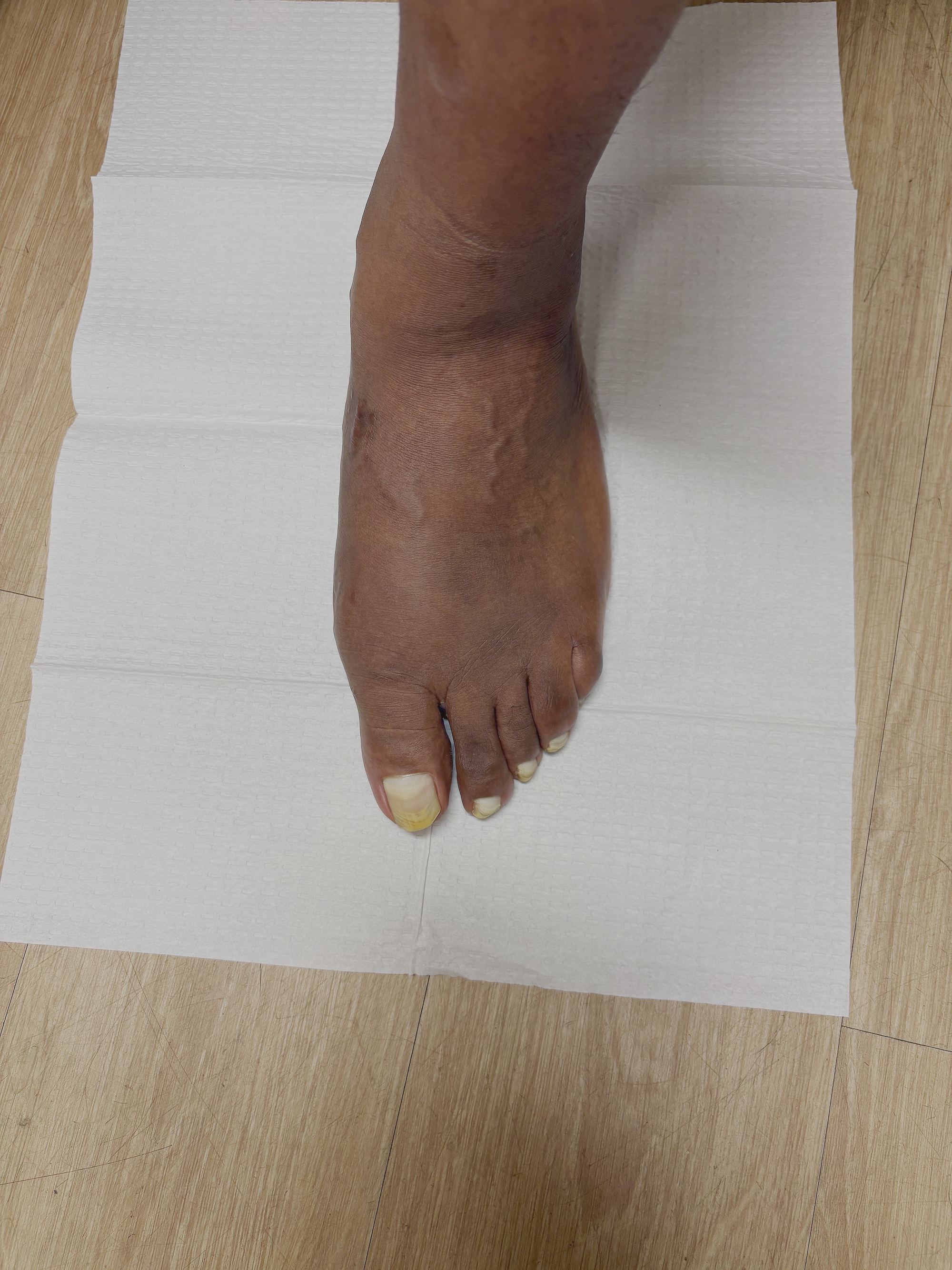 After picture of MIS Bunion Surgery