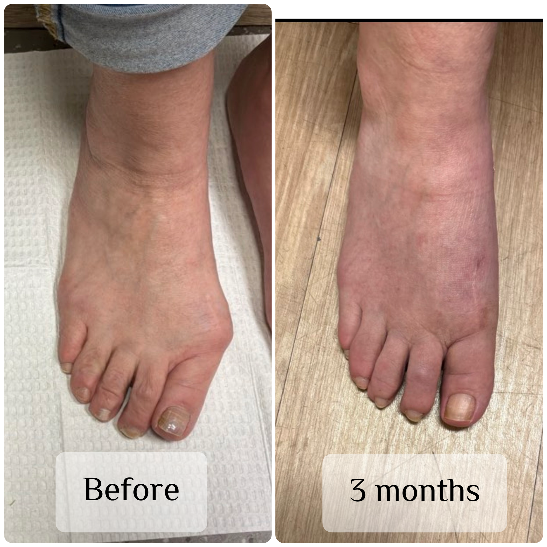 Revsion Bunion surgery using MIS techniques
