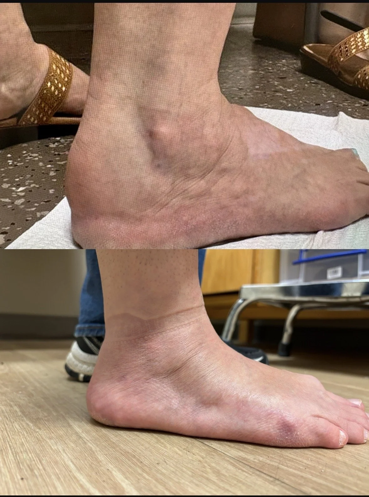 Before & After of Achilles Tendonitis