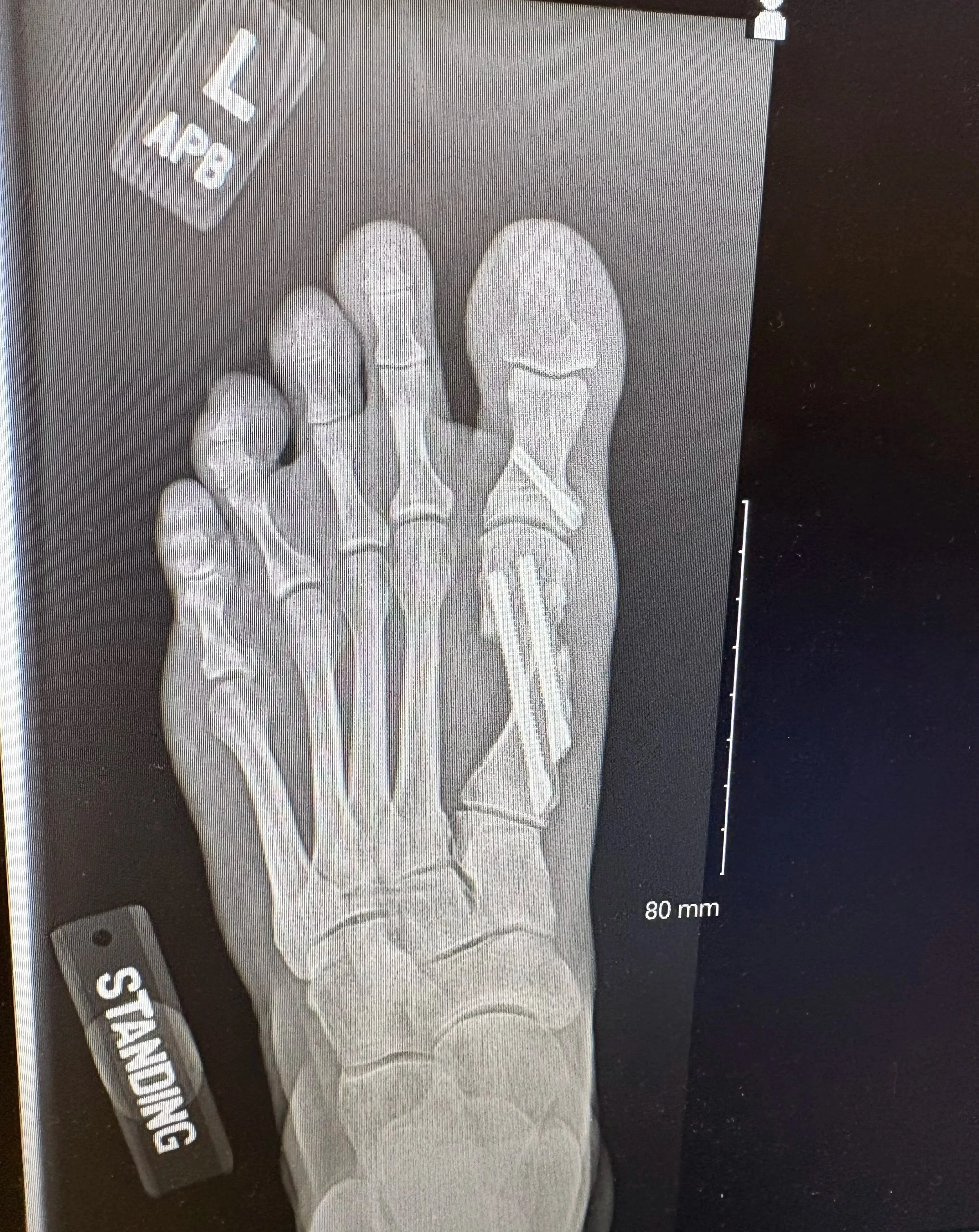MIS Foot & Ankle Surgery in Greenville, SC
