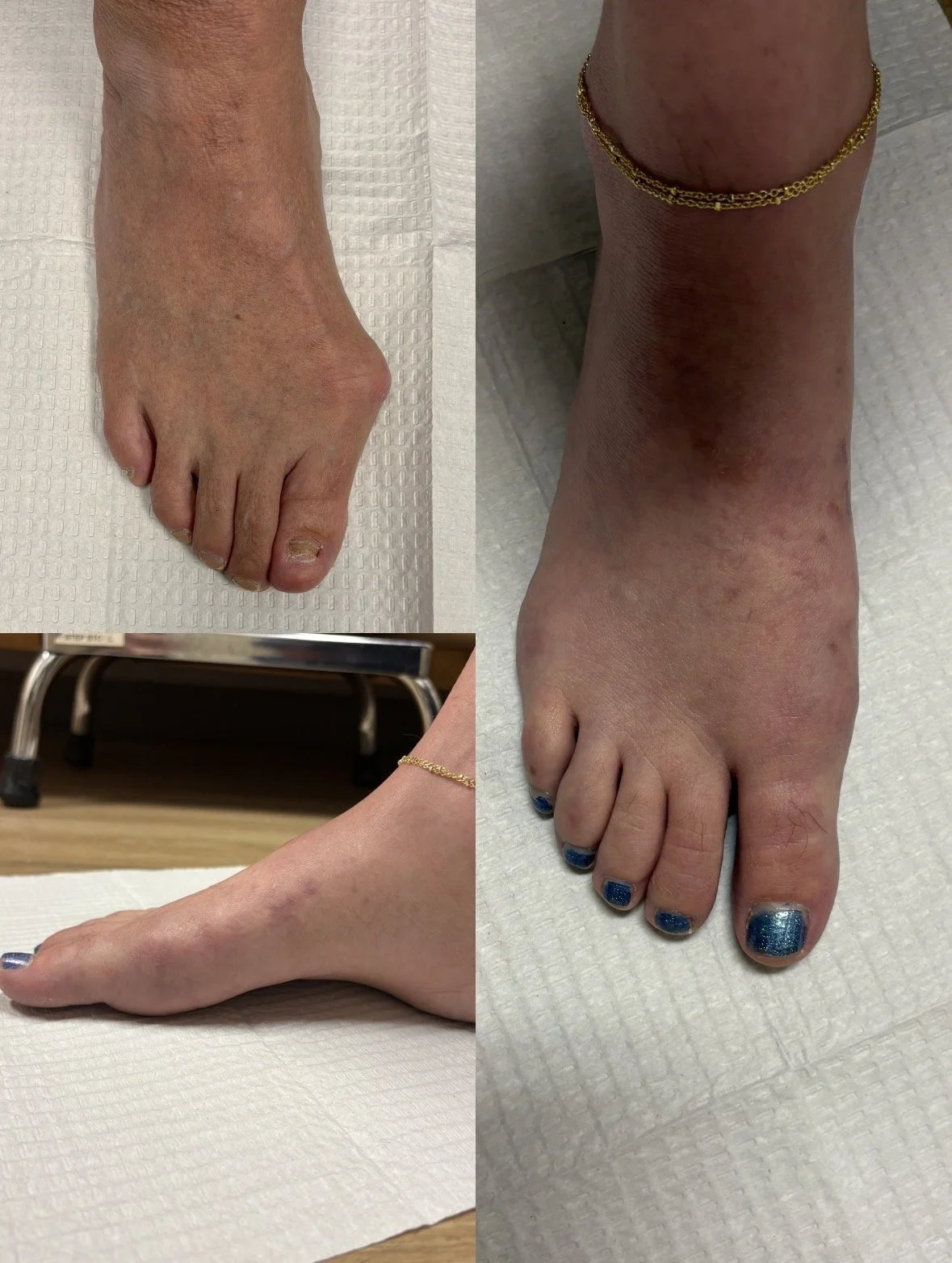 MIS Bunion Surgery Before & After Picture