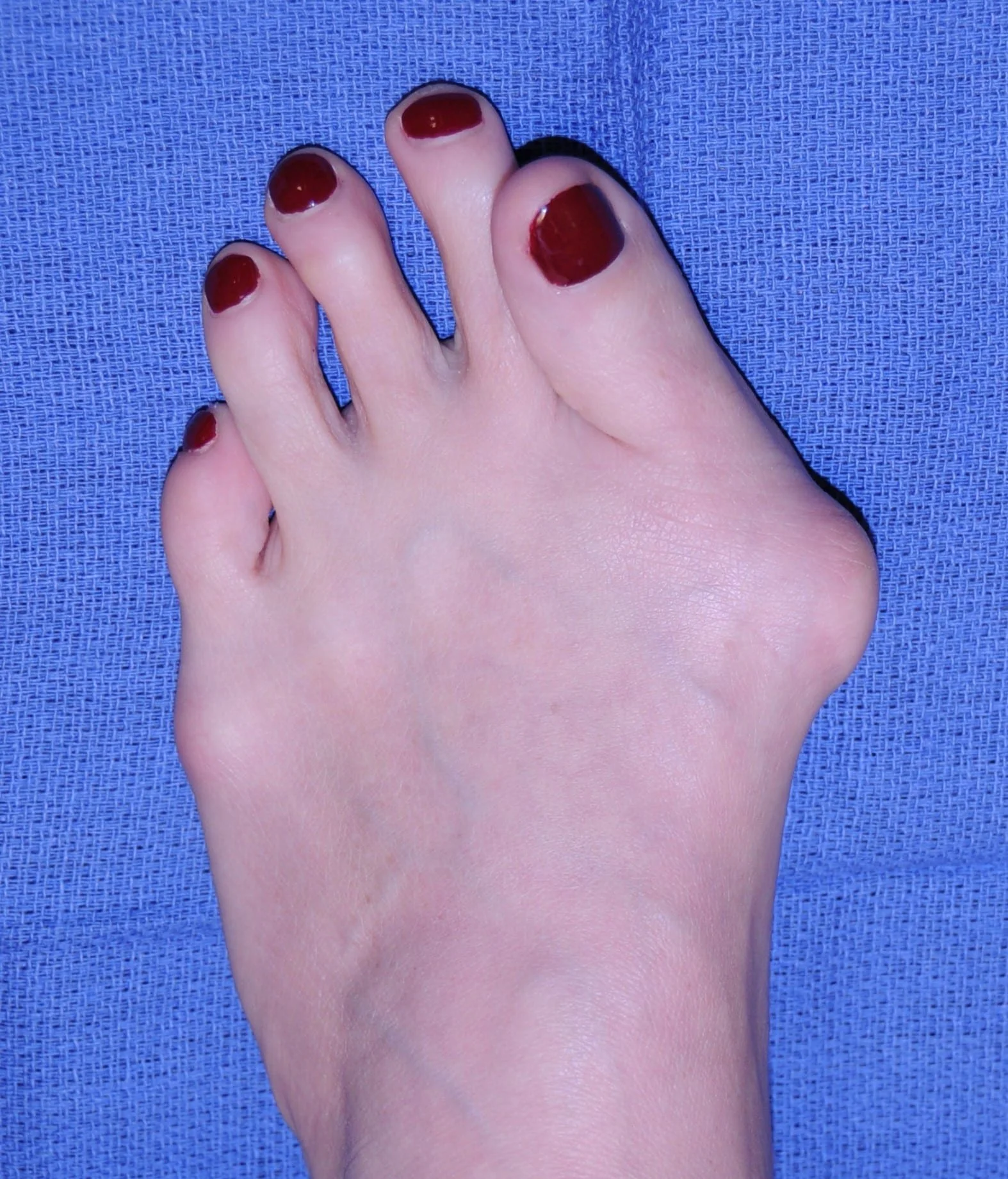 severe bunion