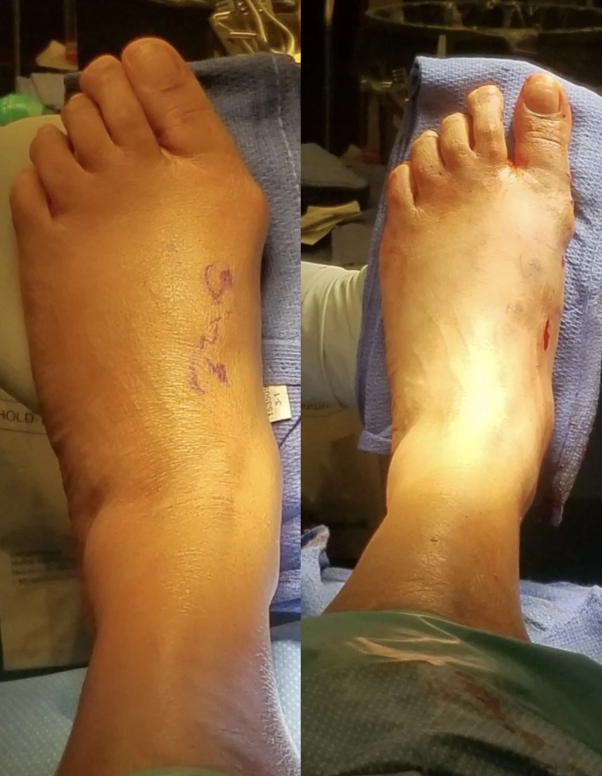 Before & After of MIS Bunion Surgery