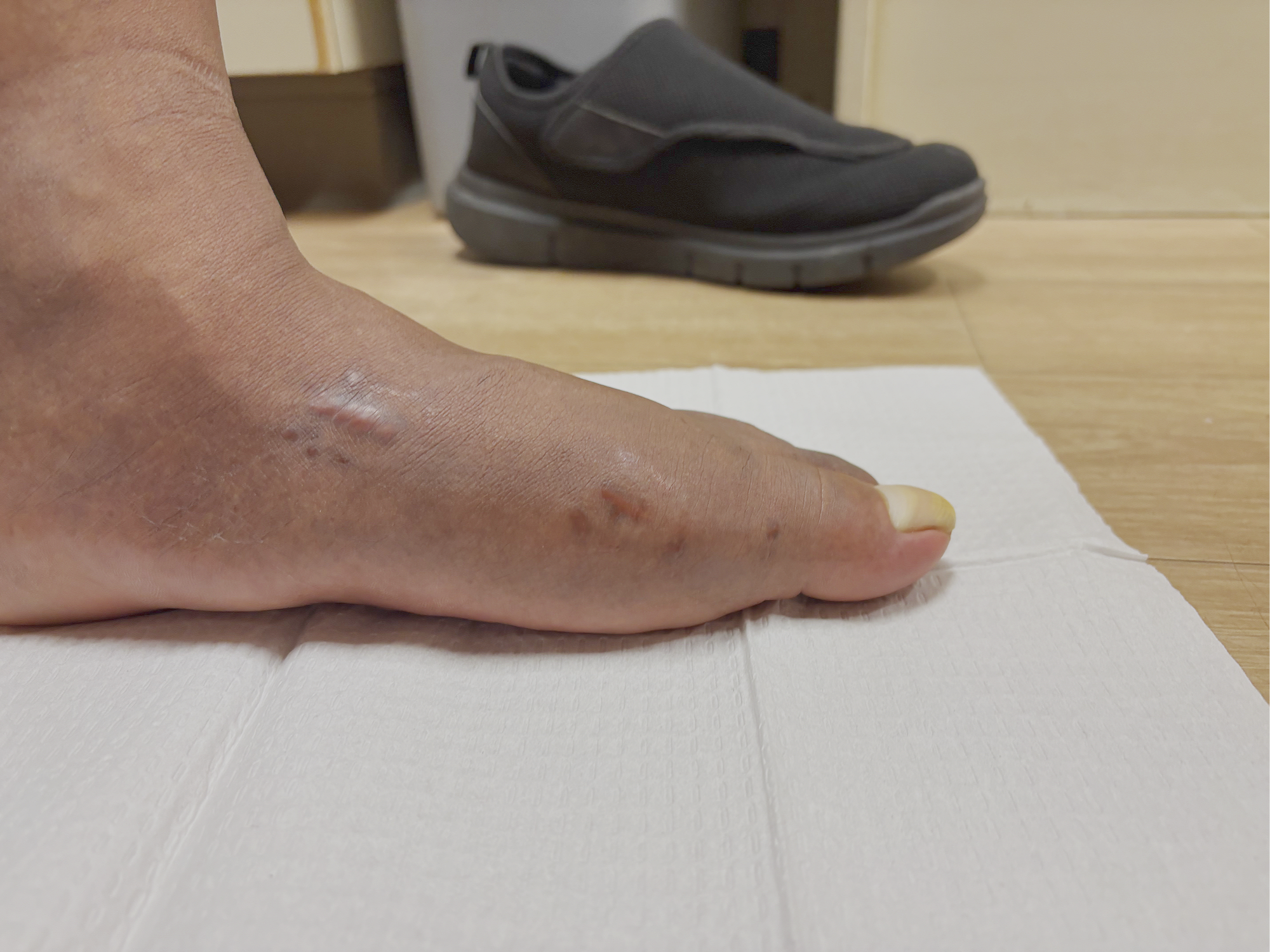 After picture of MIS Bunion Surgery