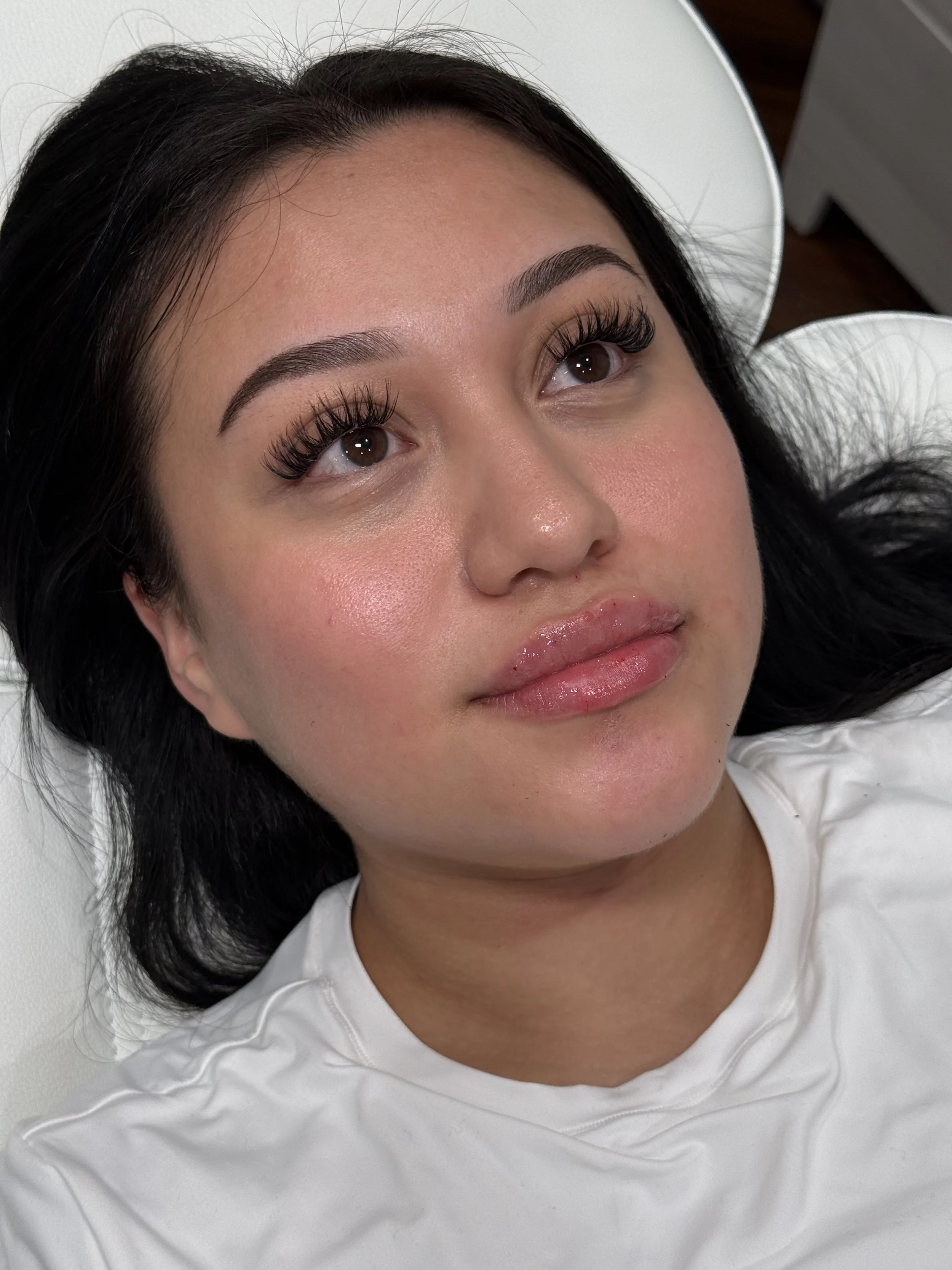 1 mL Lip Filler