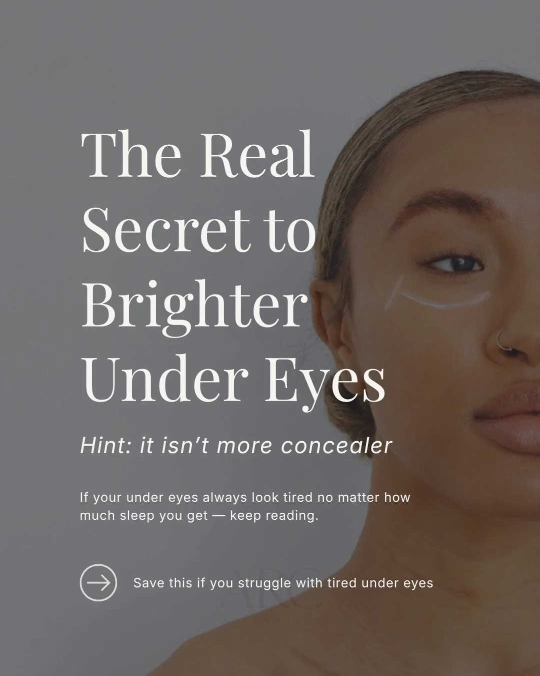 If you struggle with dark under eyes or always looking tired, this treatment is for you. 

PRP uses growth factors from your own blood to stimulate collagen and strengthen delicate under-eye skin over time, improving dark circles and brightening unde