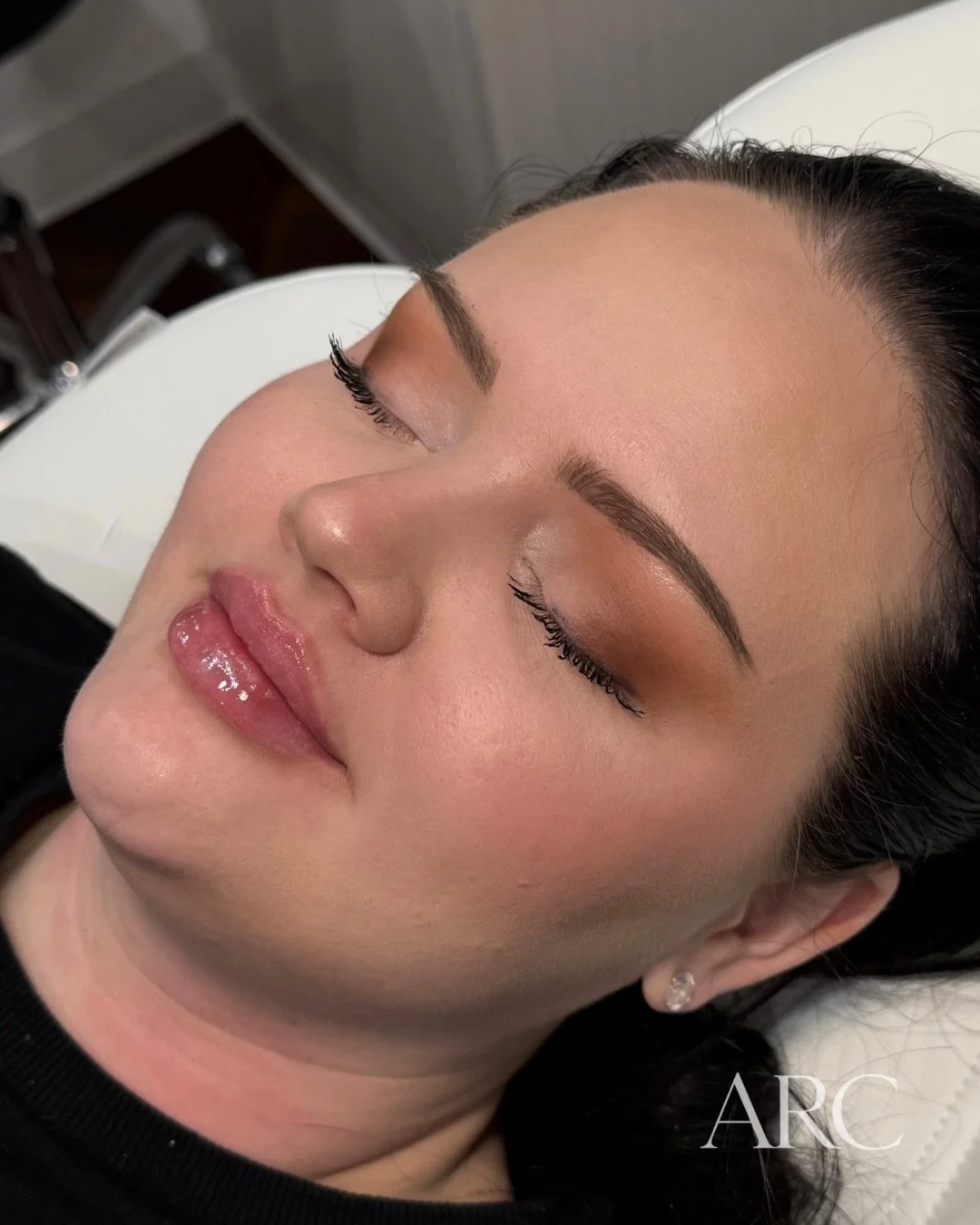 1 full syringe.

This stunning client already had a beautiful natural lip shape &mdash; she simply wanted more accentuation and volume.

(And honestly&hellip; I was a little jealous of her baseline.)

Notice what changed &mdash; and what didn&rsquo;t