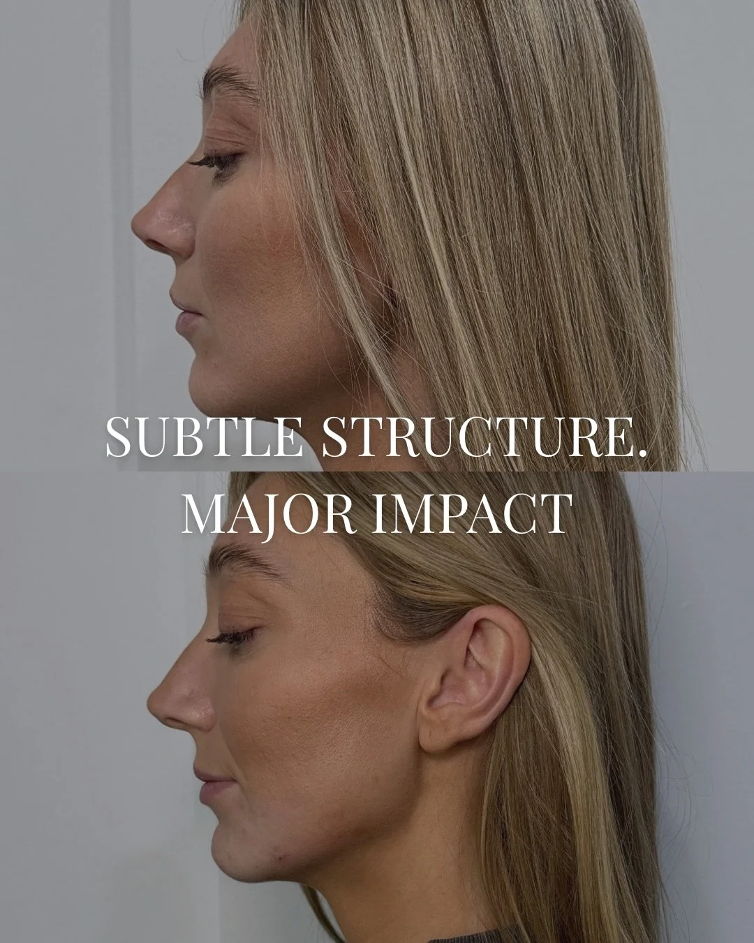 Subtle structure. Major impact.

This client wanted a subtle, natural enhancement to support her side profile.

We used 1 mL of filler placed in chin and chin shadow to gently project and refine the lower face while maintaining softness and balance.
