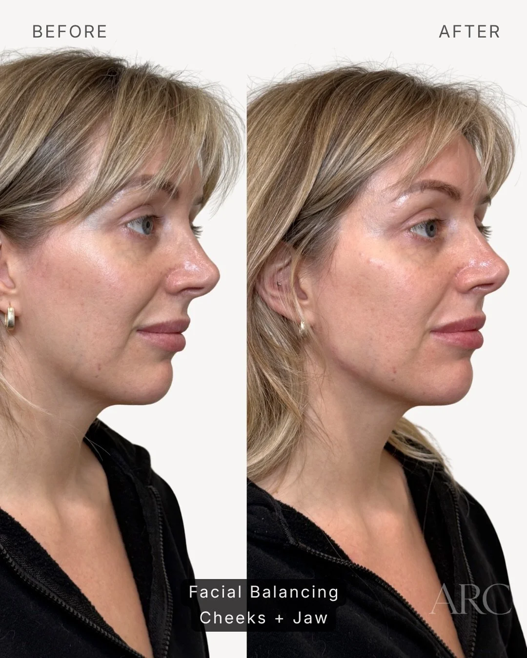 She came in wanting more definition and structure. This is what facial balancing actually does. 🖤

Cheeks and jaw |  Restored, refined, and brought into harmony. No pulling, no surgery. Just strategic placement.
And yes, she already takes incredible
