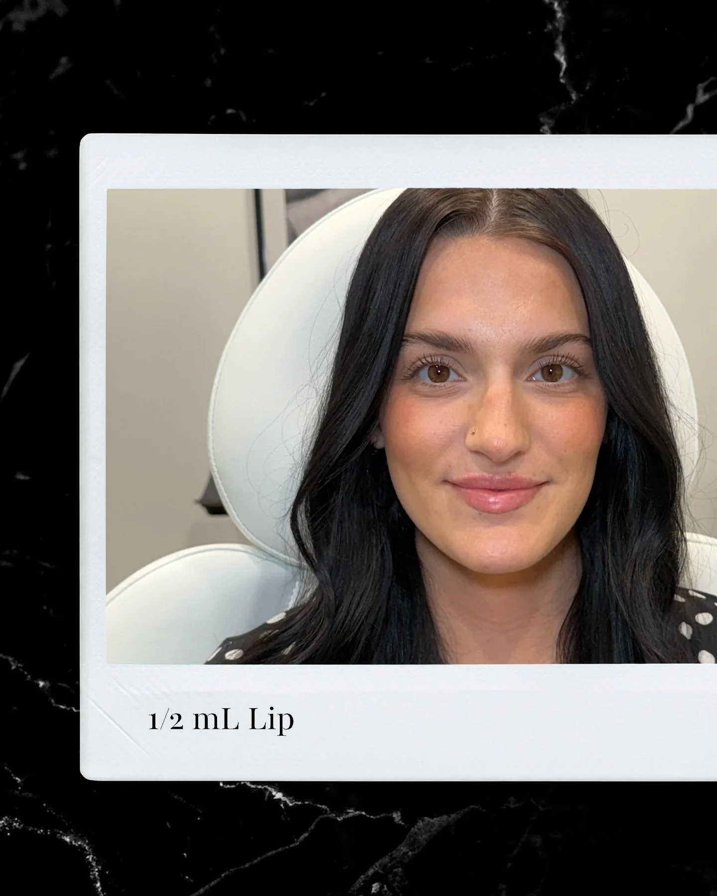 Alivia. 0.5 mL. That&rsquo;s it. 🖤 
From lip flips to her first filler &mdash; and watching her features just click into harmony was everything.
This is what the right amount in the right hands looks like. With a face card like hers we were always g