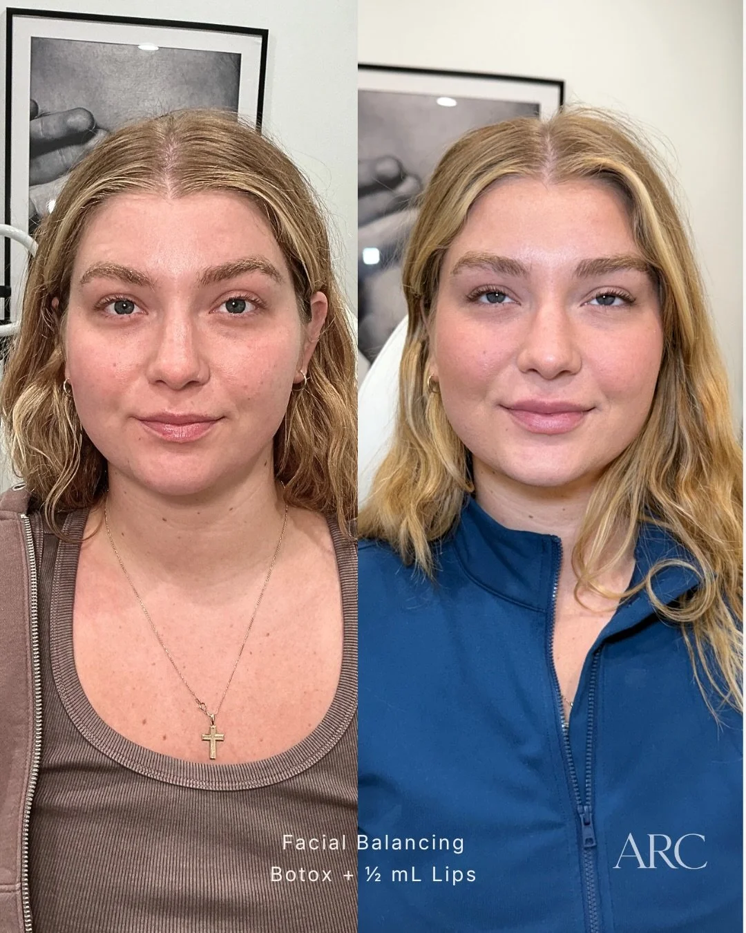 26 units of Botox + 0.5 mL lip filler | A fully customized plan built around her anatomy and her specific goals. ✨✨

The beautiful @lauren_kasik wanted a subtle pout and a refreshed appearance. Nothing overdone, nothing dramatic. Just her, but better