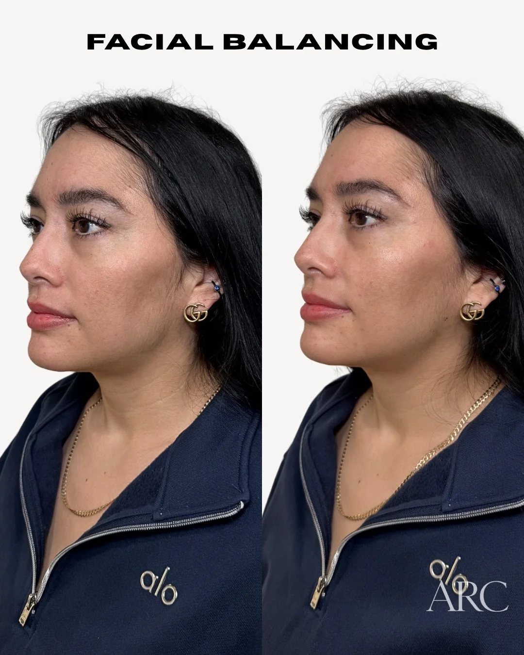 I didn&rsquo;t touch her jaw. 🖤 
She already had the bone structure. Just wanted to look more rested.
Chin shadow, smile lines, cheeks &mdash; strategically placed to blend shadows and change the way light hits the face. The rest took care of itself