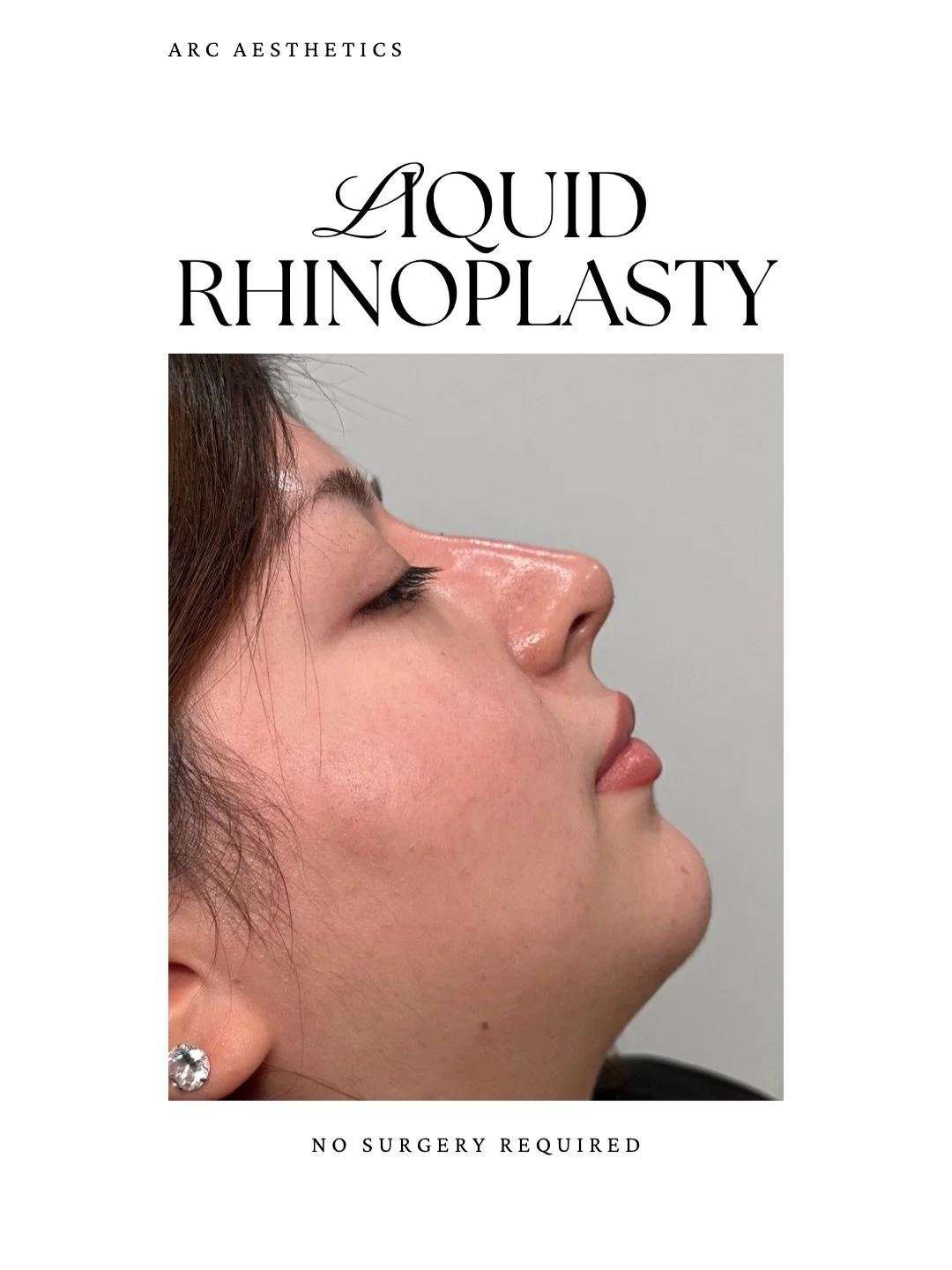 a refined profile without surgery ✨

my beautiful client wanted to smooth the bridge and subtly lift the tip of her nose.

small, precise changes that bring everything into balance ⚖️

liquid rhinoplasty at ARC | booking via link in bio

#liquidrhino